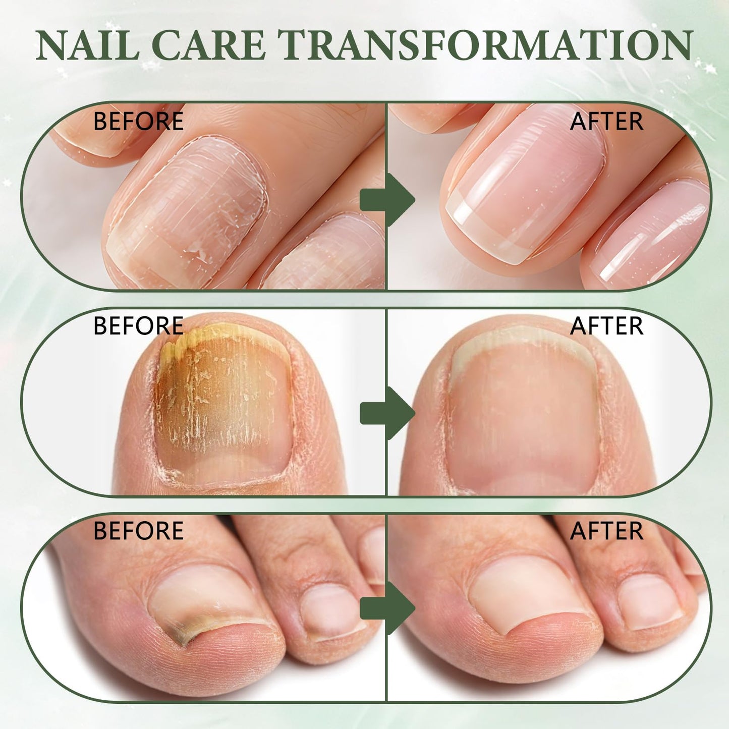 Nail Repair Gel, Nail Growth Serum, Toe Nail homFungusgo, Nail Strengthening Serum for Damaged, homBrittle & Thin Nails, Nourishing Formula, Fast Absorbing, Enhances Nail Appearance 20g