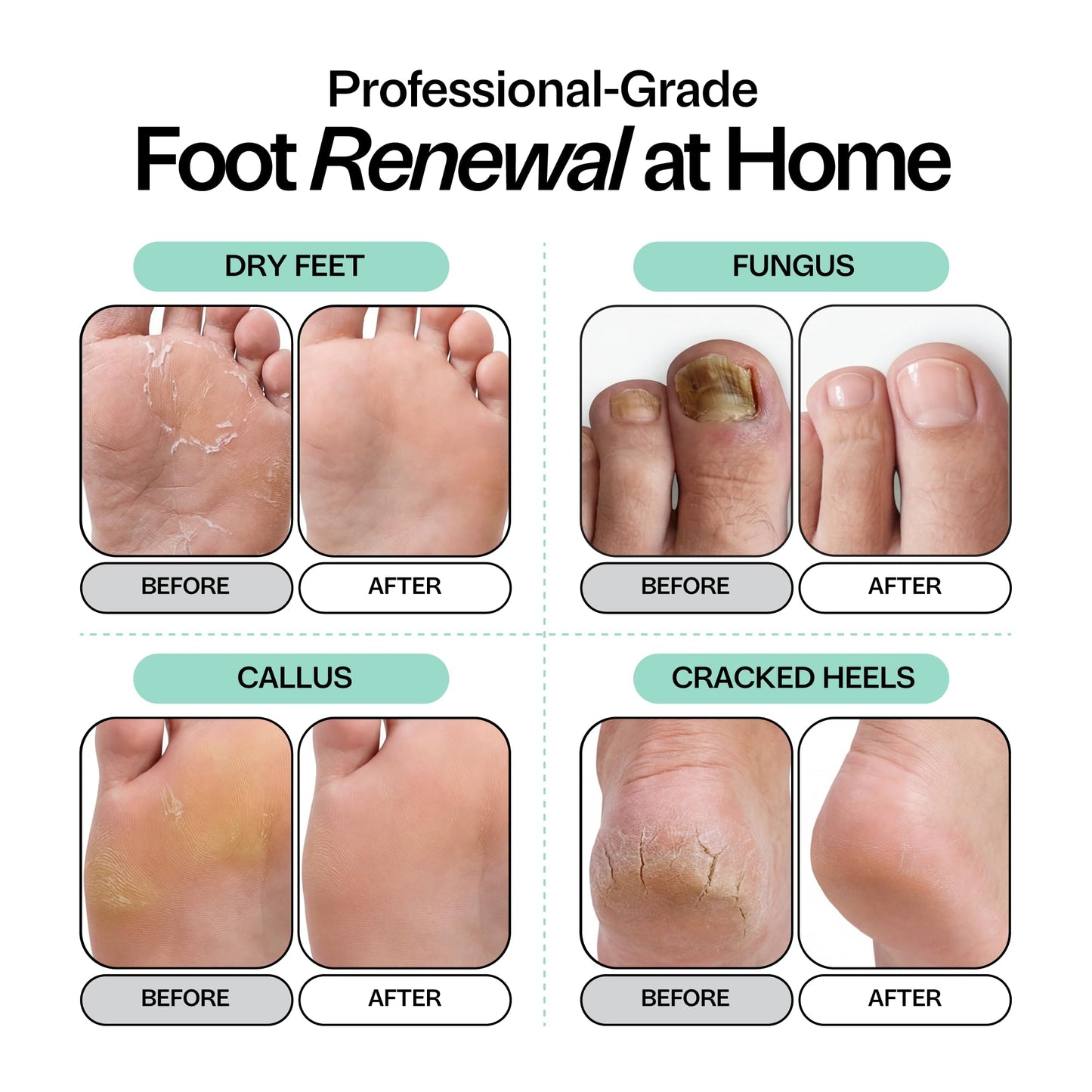 Foot Choice Tea Tree Oil Foot Soak with Epsom Salt - For Toenail Repair, Odor Elimination & Softening Calluses - Soothes Tired, Sore Feet & Itchy Skin - Made in USA, 16 oz