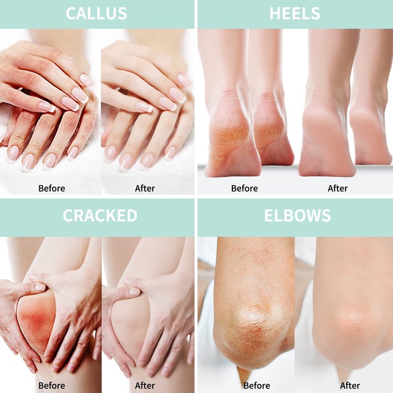 Grocerism 2 Packs Urea Cream 20% Plus 2% Salicylic Acid 5.3oz || Foot Cream Maximum Strength with Hyaluronic Acid, Tea Tree and Aloe Vera for Deep Moisturizes, Callus Remover and Soften