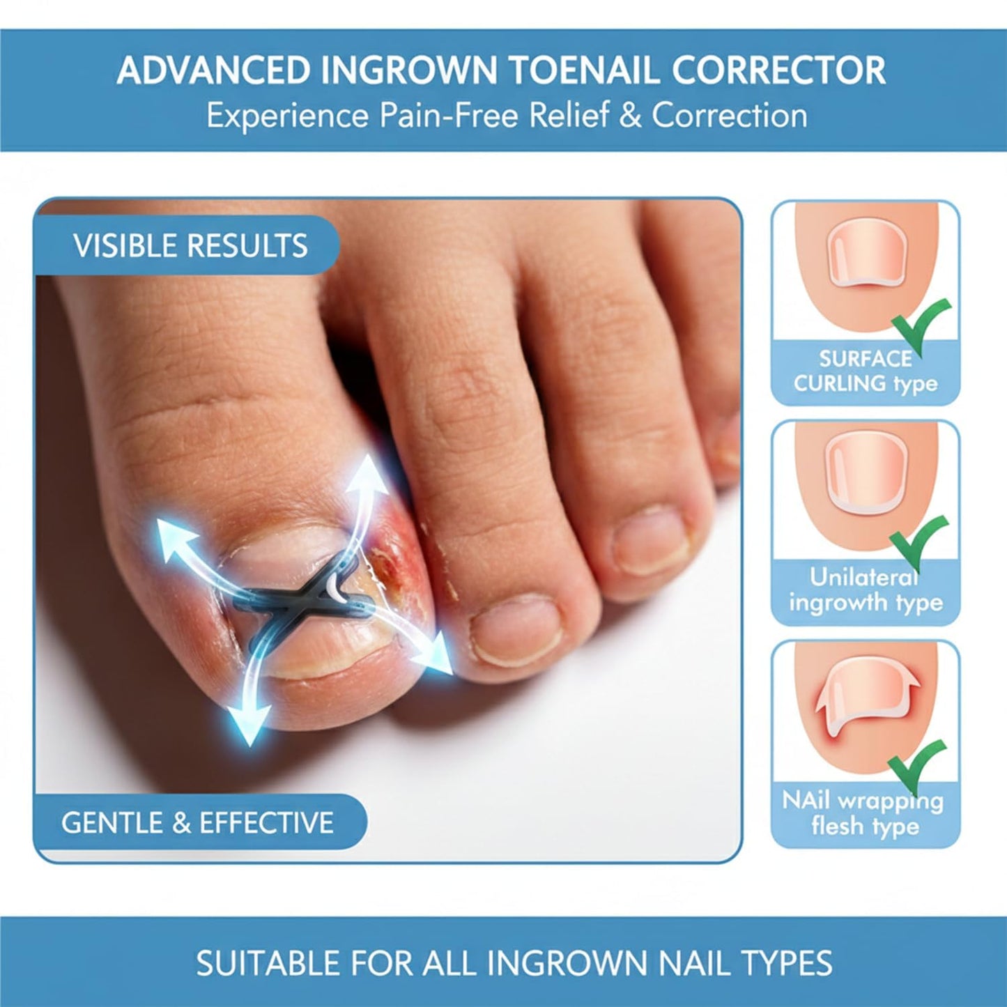 Ingrown Toenail Treatment Corrector Strips, Titanium Alloy Ingrown Nail Curve Corrector, Ingrown Toenail Tools for Home Use, 6Pcs