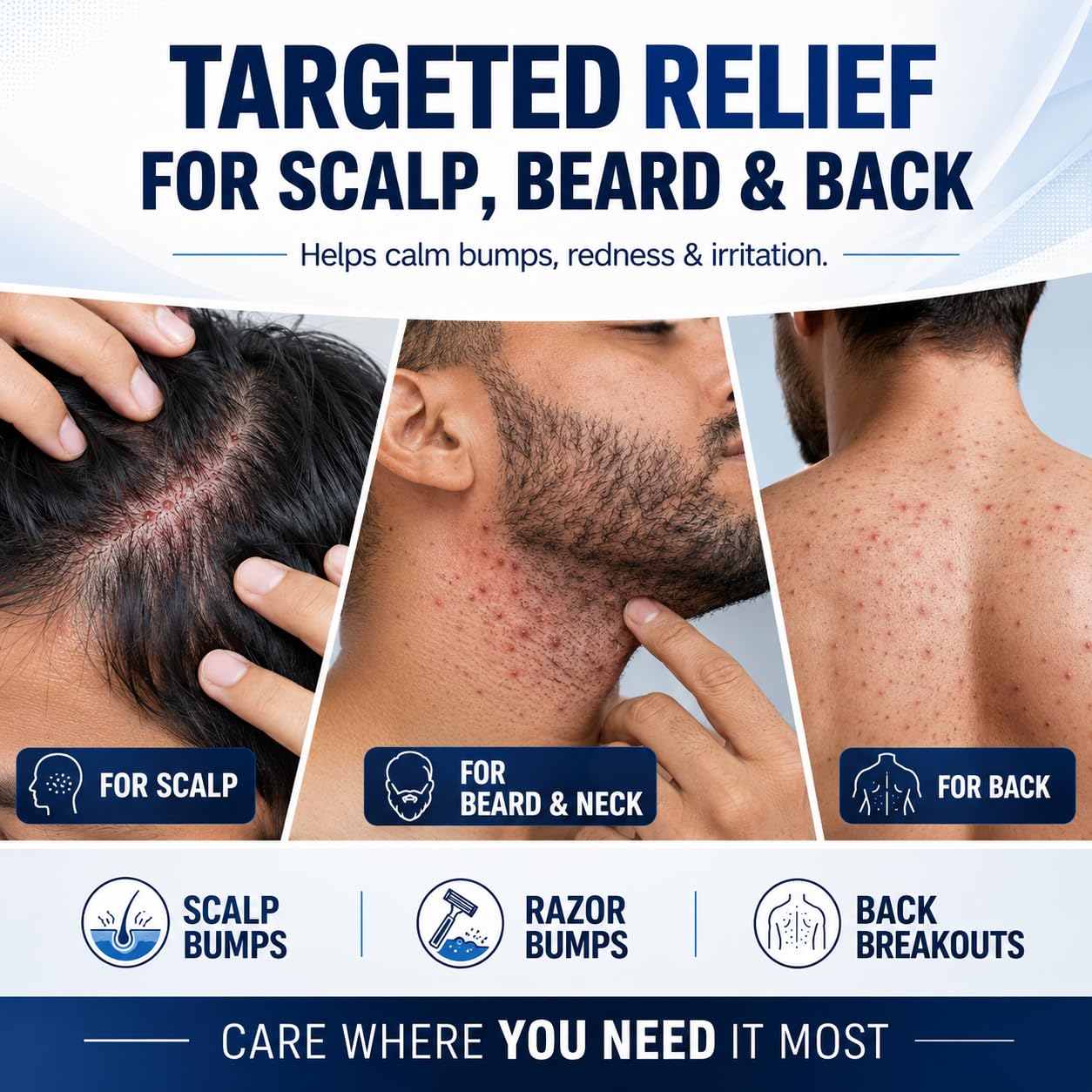 Razor Bumps & Ingrown Hair Folliculitis Treatment Cream – 5% Benzoyl Peroxide for Scalp Bumps & Body Acne – Fast-Acting Relief for Shaving Irritation, Redness & Bumps with Tea Tree & Centella, 3.53 oz
