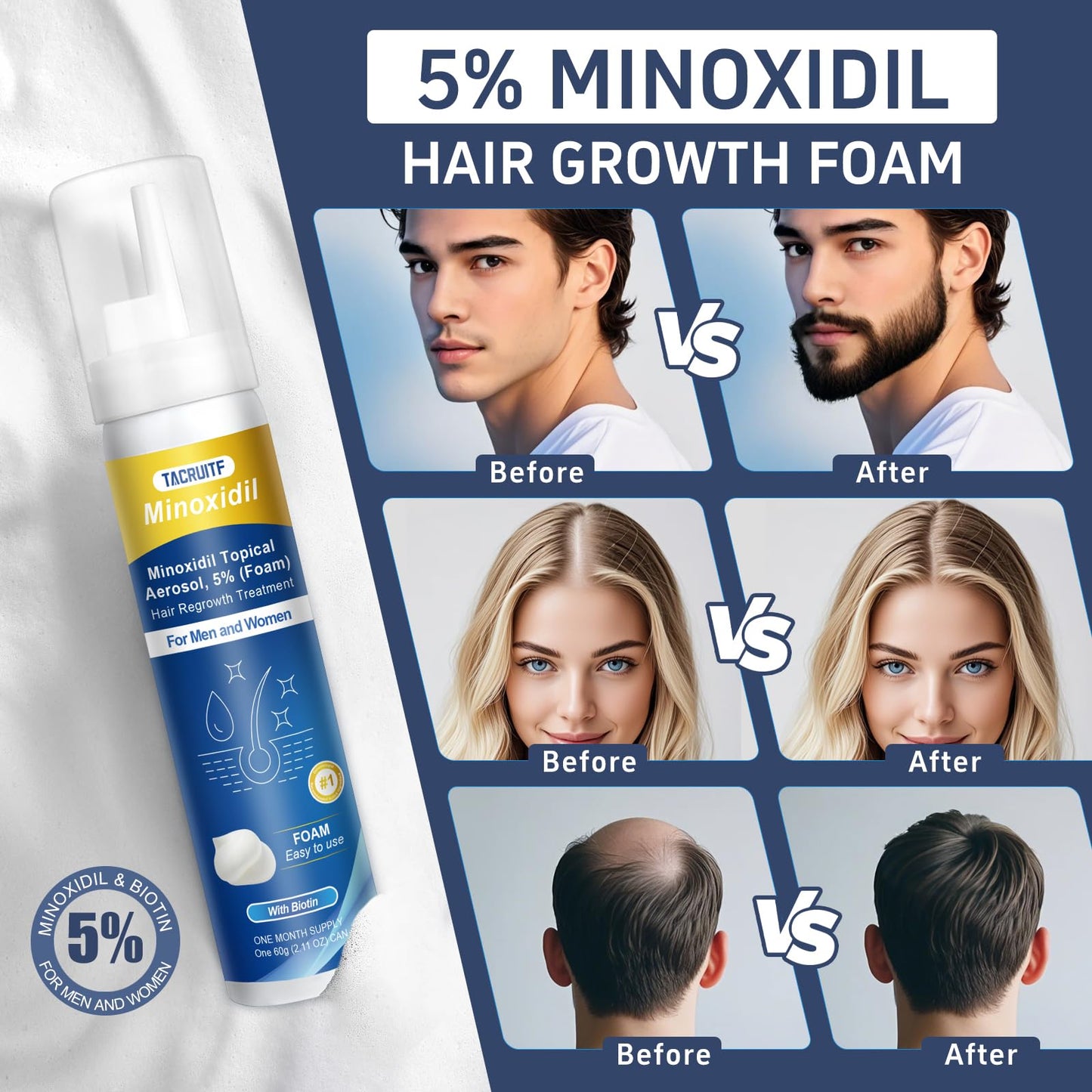 Minoxidil Foam, 5% Topical Minoxidil Foam, Infused with Biotin, Hair Growth Treatment, Minoxidil for Men and Women, Supports Thicker and Fuller Hair & Beard (4.22oz, 2 Month Supply)