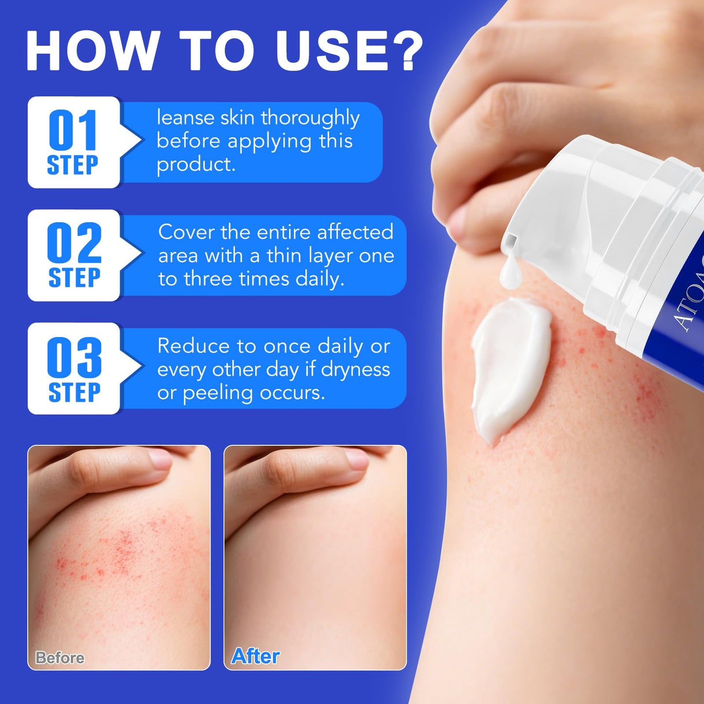 Cystic Acne & Folliculitis Care Cream for Face and Body - 1% Salicylic Acid & Multi-Acid Complex - Stubborn Spot Blemish, Pimple & Butt Breakout Clearing Control - Suitable for Sensitive Skin