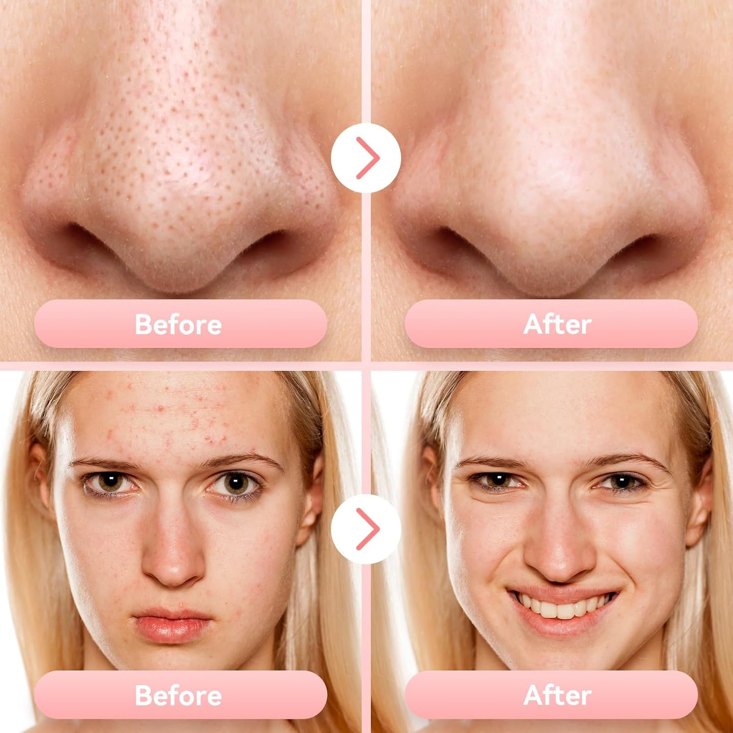 Blackhead Remover Pore Vacuum - Upgraded Facial Cleaner Tool with 5 Suction Levels & 5 Probes
