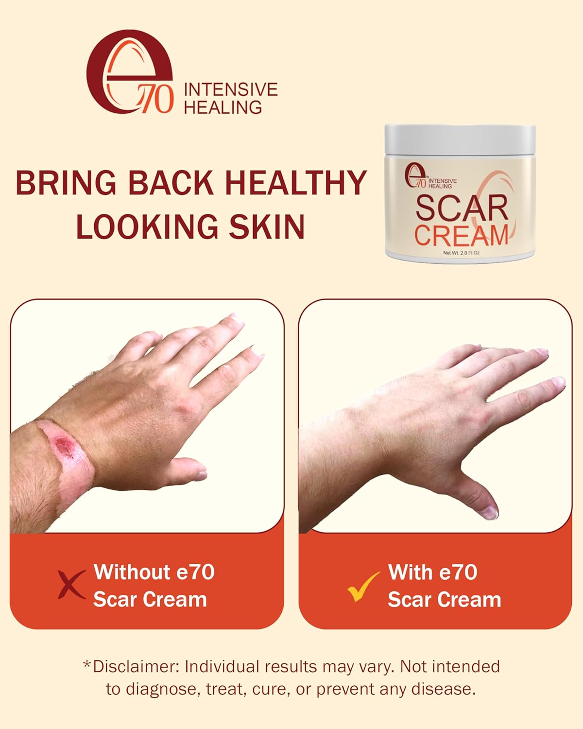 Scar Cream Gel for Surgical Scars | Fast Repair for C-Section, Keloids & Burns - 2.0 Fl Oz, All Skin Types