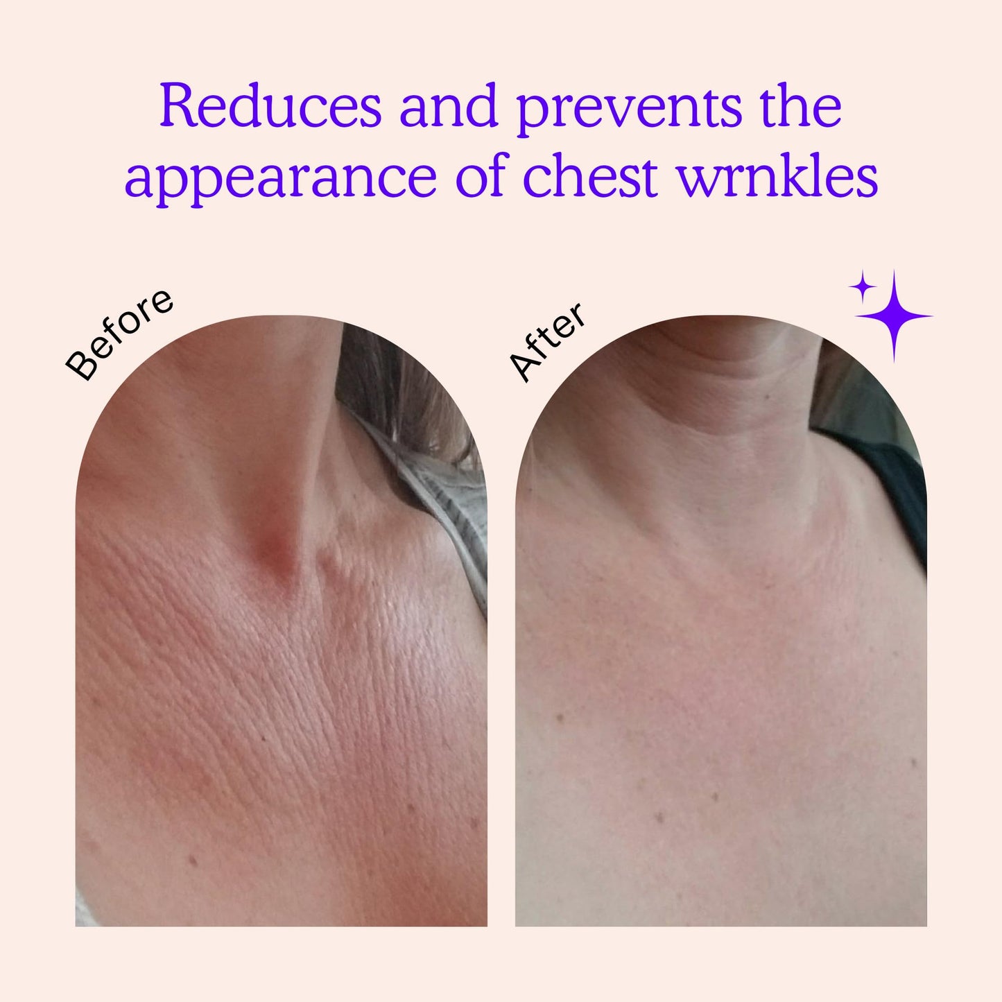 BLUMBODY Chest Wrinkle Pads – Anti-Wrinkle Silicone Patches Skin Firming, Smoothing – Reusable Overnight Chest Pads – Anti-Aging Crepe Erase Pad – Neck, Décolleté (1-Month Supply)