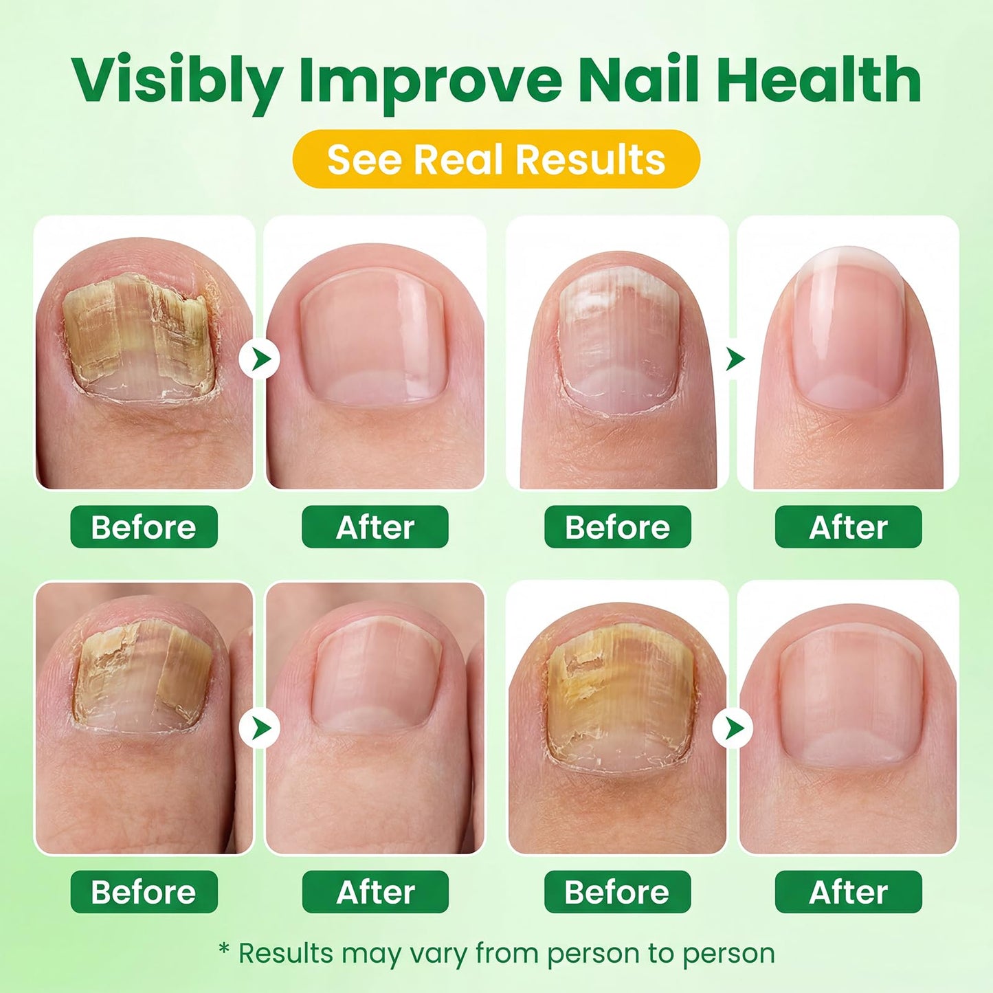 High capacity Nail Pen-16 ml per unit,Toenail Pen Treatment for Toenails & Fingernails, 25% Undecylenic Acid Formula （3-Pack Twist Pen ）