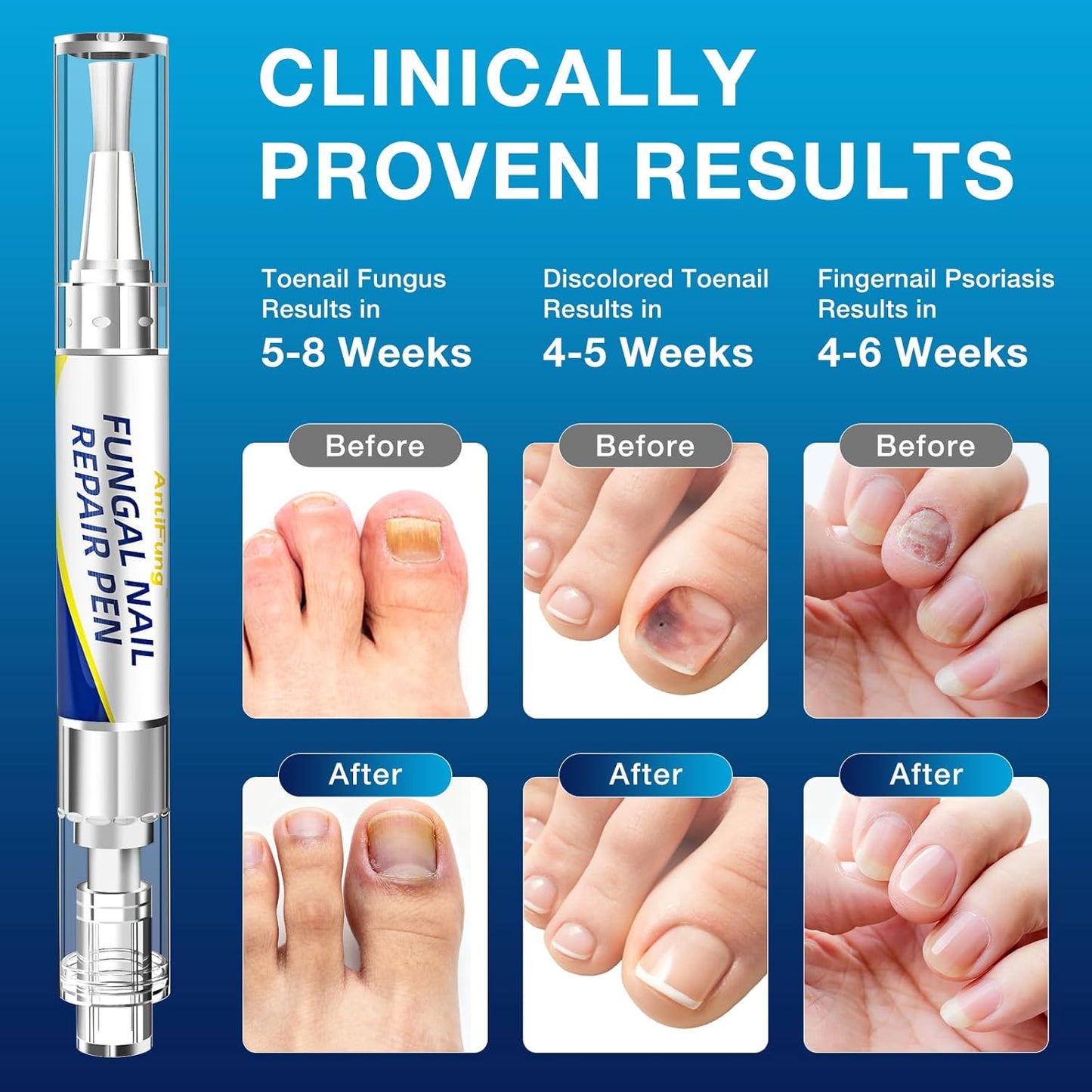 Toenail Fungus Treatment - Extra Strength Anti-Fungal Pen | 25% Undecylenic Acid for Damaged & Discolored Nails - 3-Pack