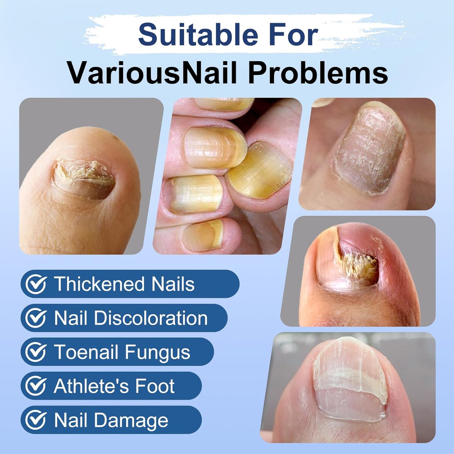 Toenail Fungus Treatment - Extra Strength Fungi Nail Pen with 25% Undecylenic Acid | 6 Pcs for Yellow, Thick, Brittle Nails
