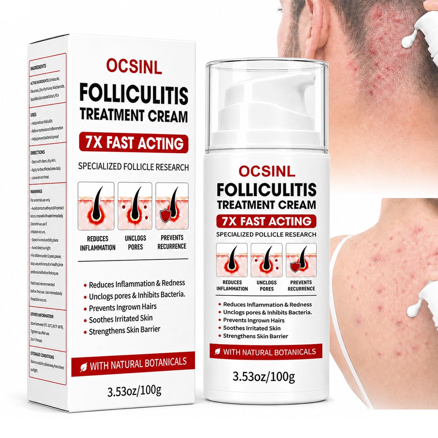 OCSINL Folliculitis Cream 5% Benzoyl Peroxide Scalp Body Care