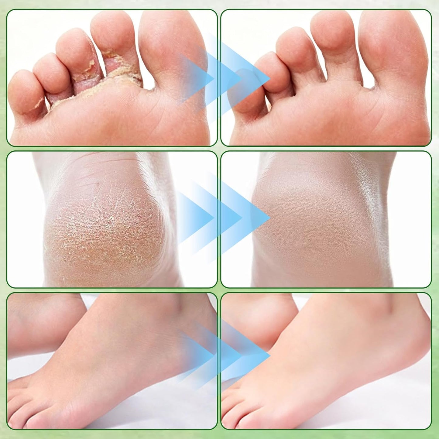Tea Tree Oil Foot Cream - Nourishing Hydration with Vitamin E & Aloe Vera | 50g/1.764oz for Dry Cracked Feet, Hands & Elbows