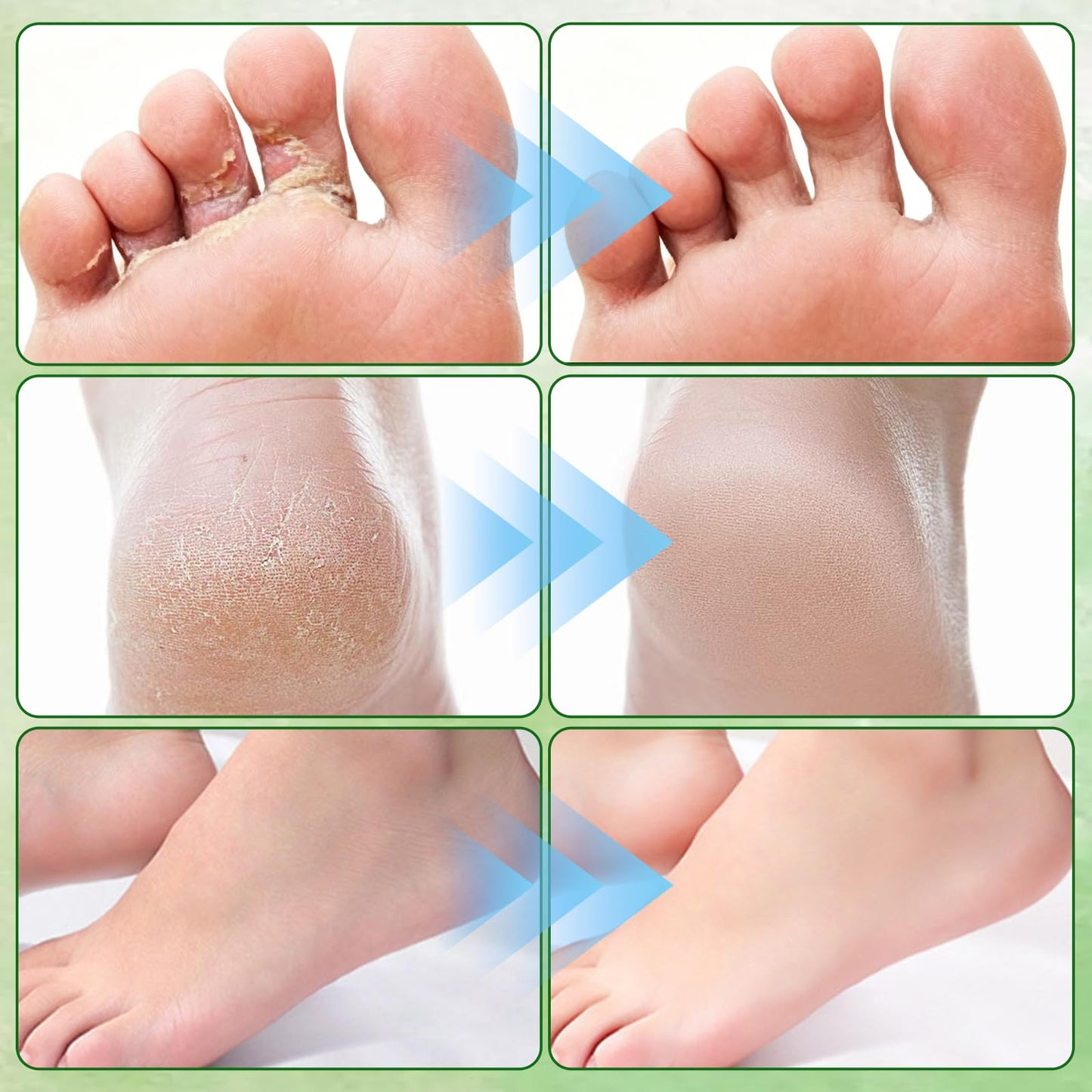 NUOKOU 2PCS Tea Tree Oil Foot Cream,with Vitamin E, Aloe Vera & Peppermint, Nourishing & Hydrating,Natural Formula for Skin
