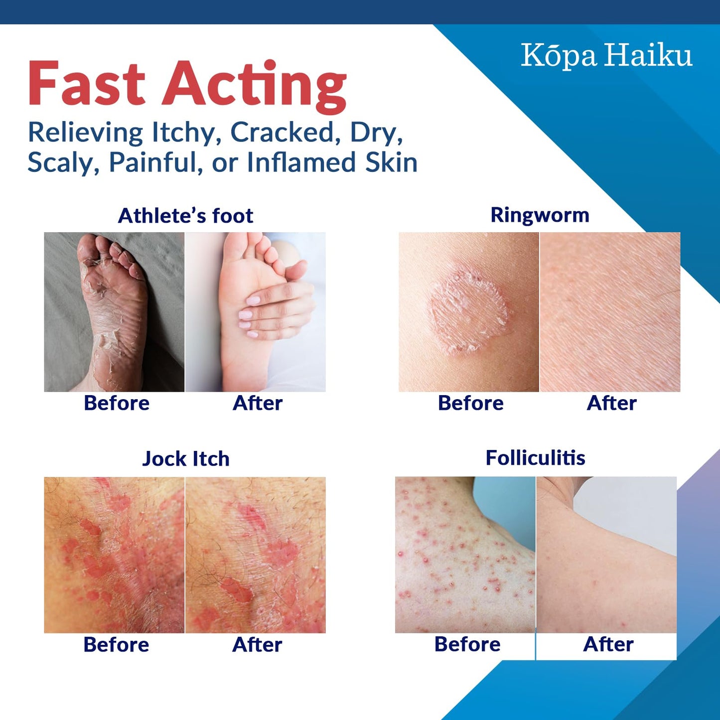 KOPA HAIKU Antifungal Cream: Treatment for Ringworm, Athlete’s Foot & Jock Itch, Perioral Dermatitis & Seborrheic Dermatitis 1 oz