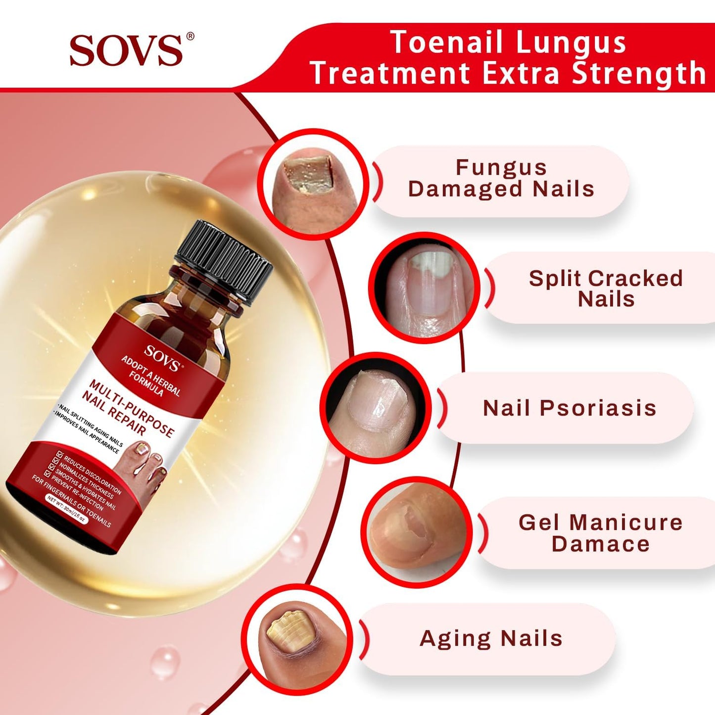 SOVS Toenail Treatment,Gentle Formula, Effectively Improves Nails for a More Beautiful Appearance（1pcs）