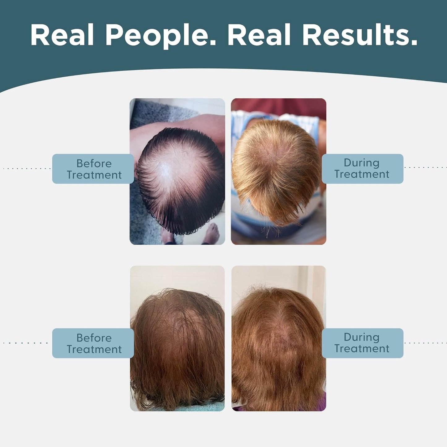 Minoxidil 5% Hair Growth Serum for Men | Promotes Regrowth & Reactivates Follicles - 1 Month Supply