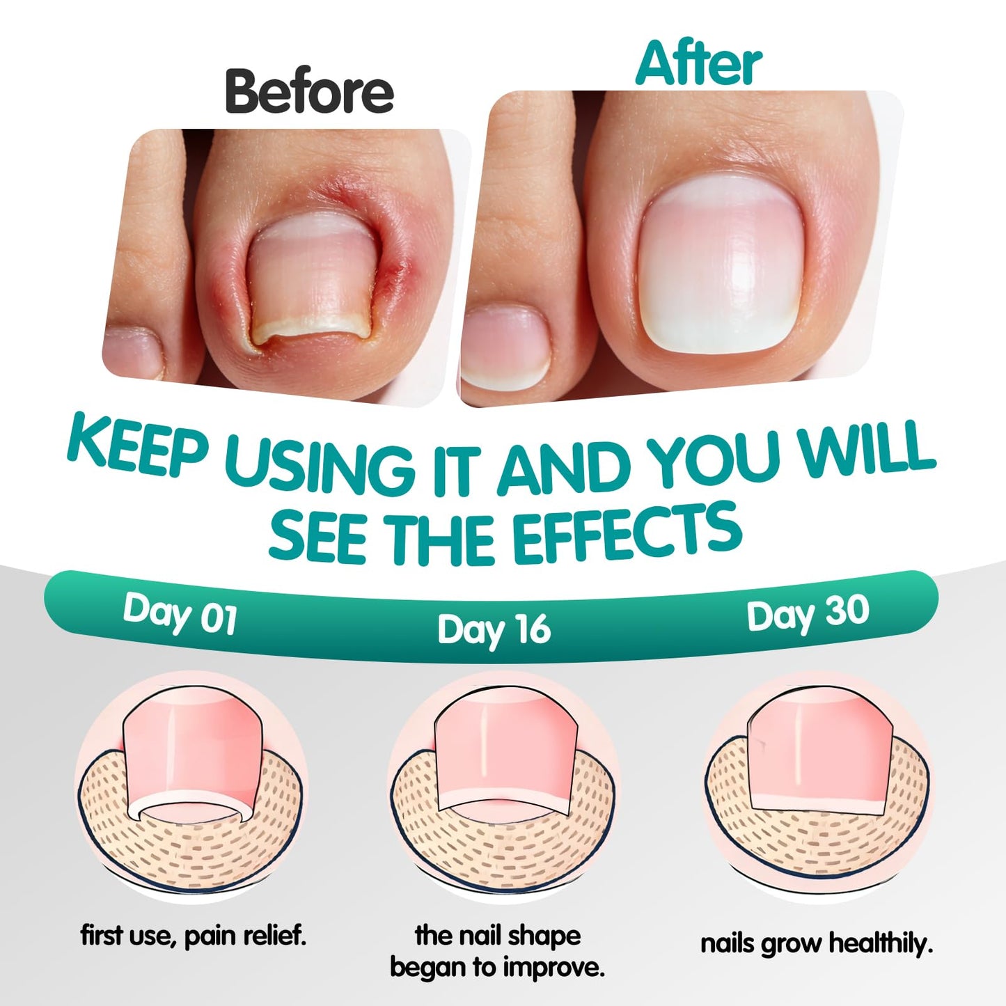 60 Pcs Breathable Ingrown Toenail Strips, Toenail Corrector Patch for Ingrown Toenail Relief, Painless Toenail Support Tool