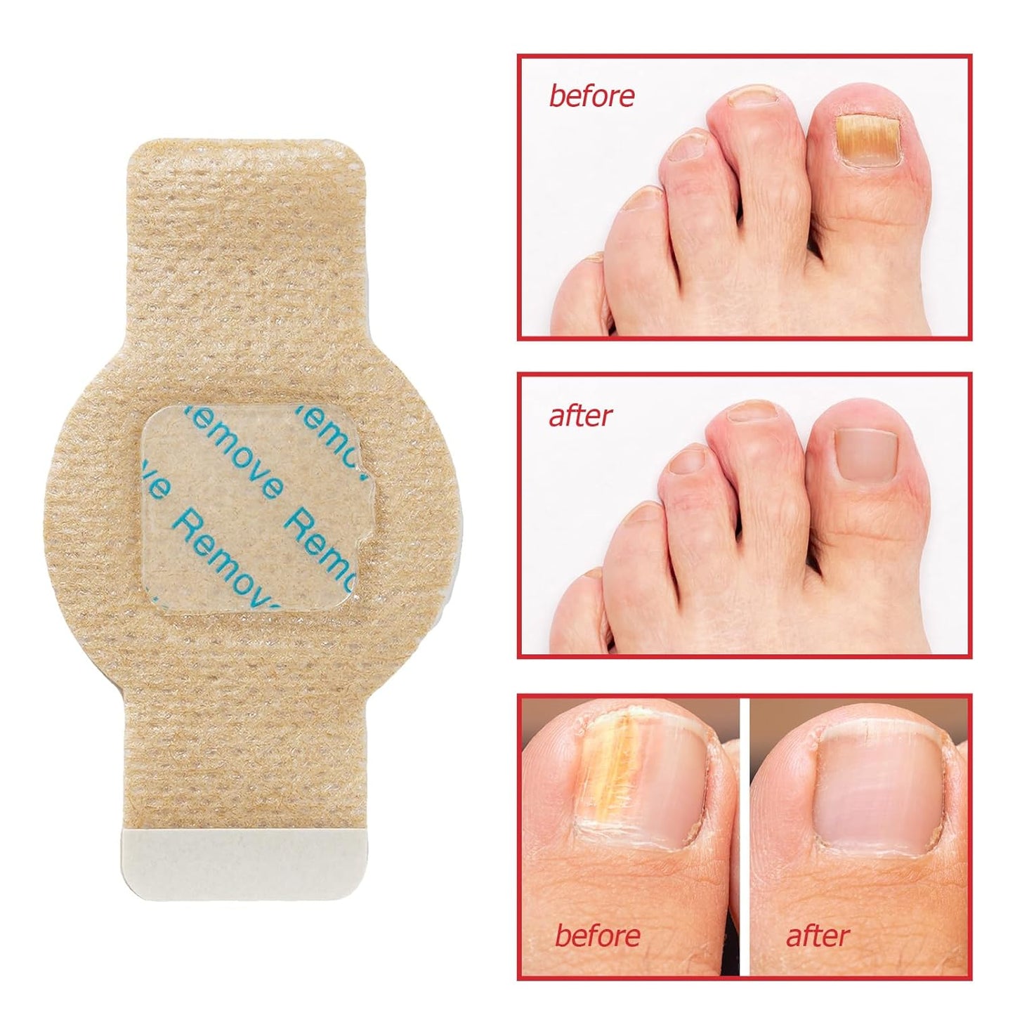 Fungal Nail Patches - Extra Strength Toenail Treatment for Damaged Nails | 21 Pcs