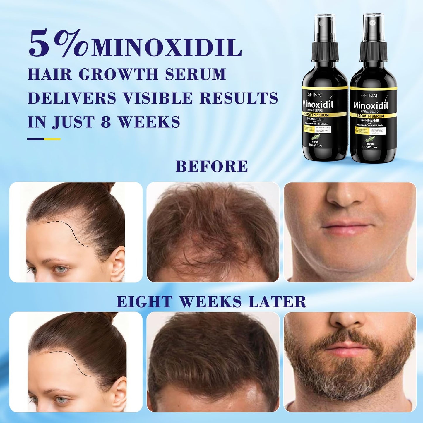 5% Minoxidil Spray for Men and Women Hair Loss Solution with Biotin and Rosemary Hair Growth Serum, Extra Strength 5 Percent Minoxidil for Thicker Fuller Hair Regrowth, 1.96 Fl Oz (Pack of 2)
