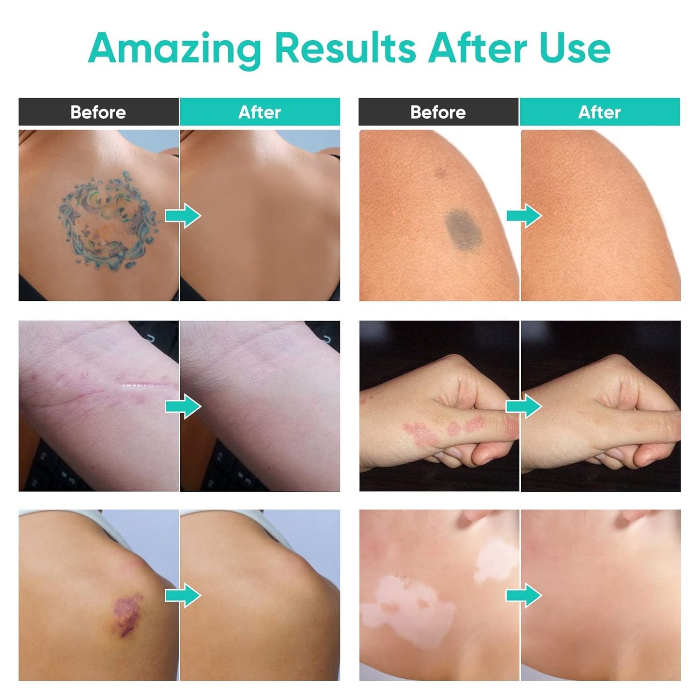 Tattoo Cover Up Makeup - Waterproof Concealer Cream for Scars, Vitiligo & Dark Spots | 2 Color Options