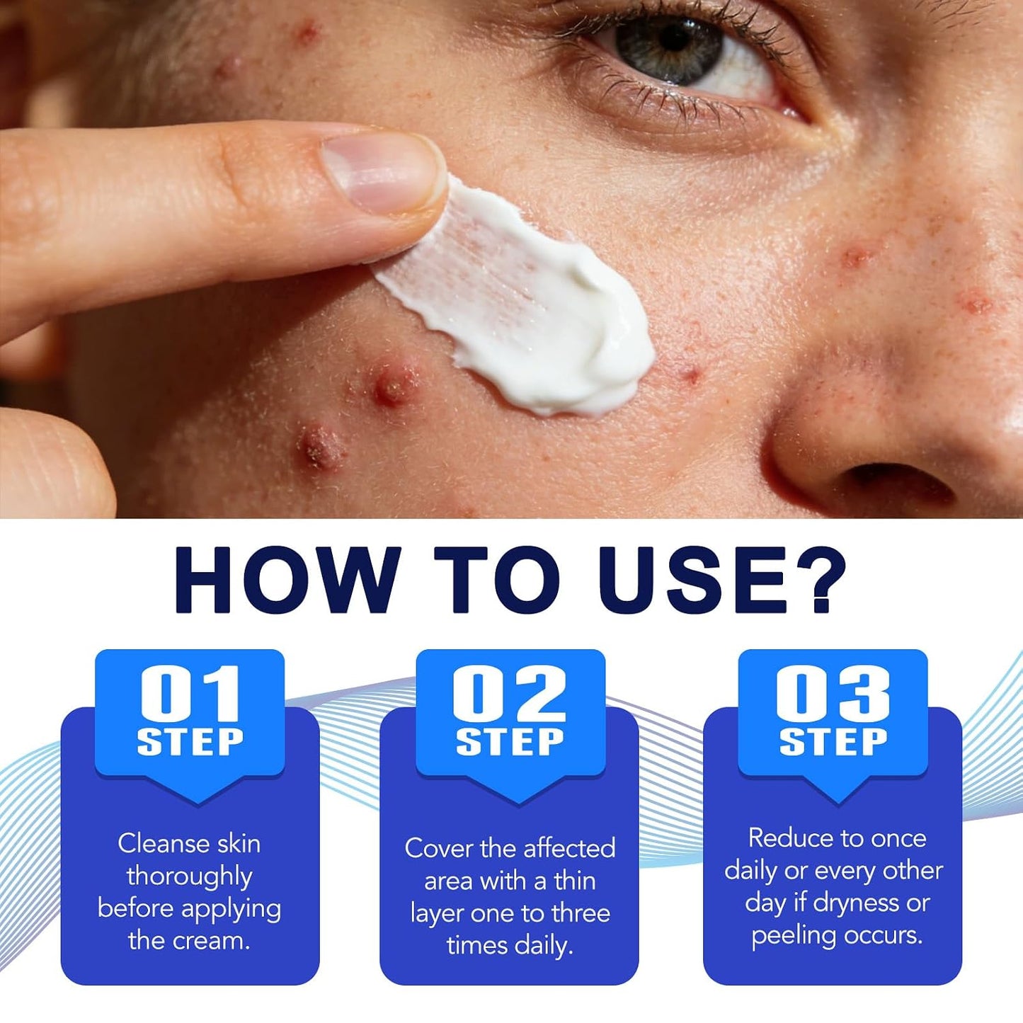 Folliculitis Cream - 1% Salicylic Acid & Herbal Extracts | Pore Refining, Multi-Area Use for Scalp, Face & Body, 100g