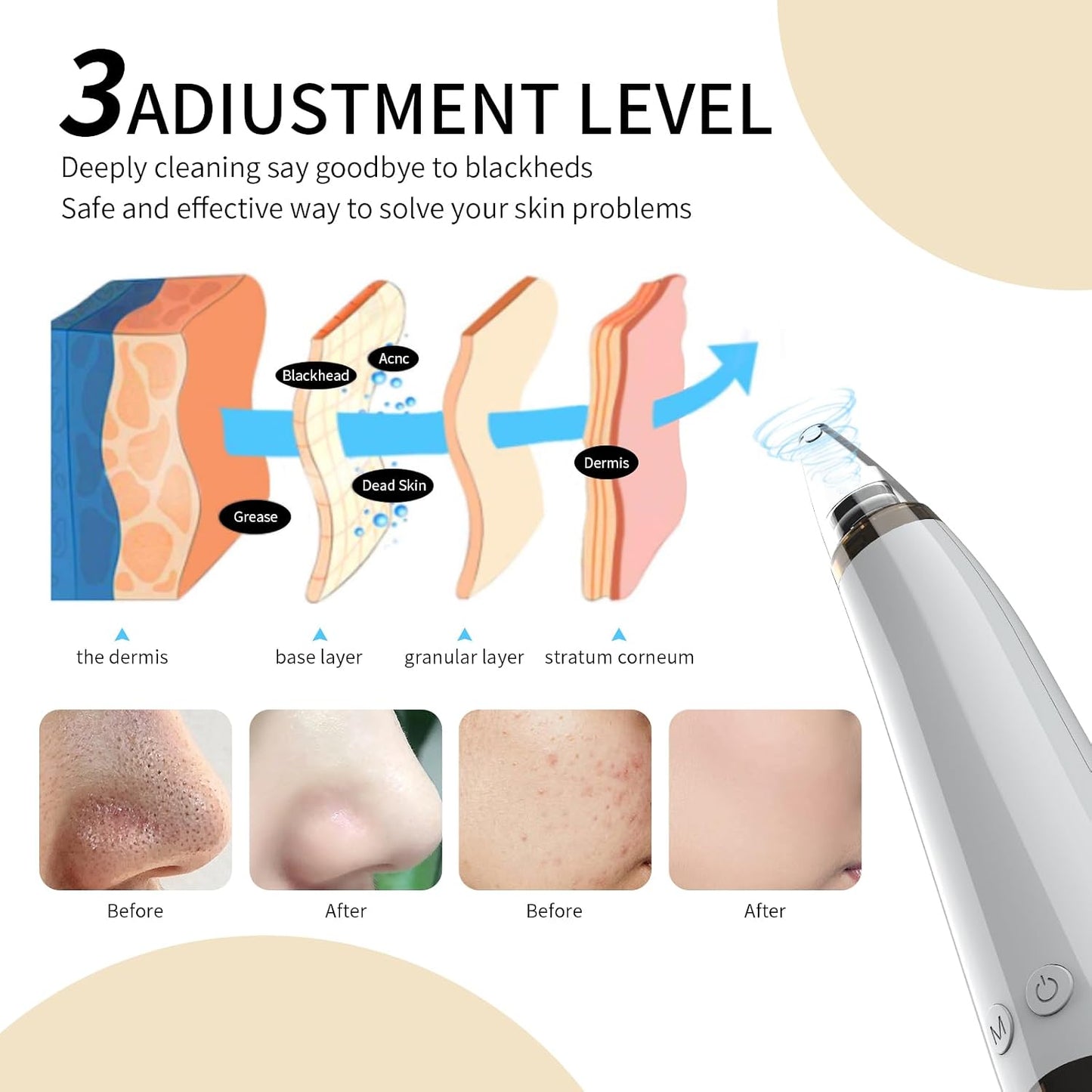 Blackhead Remover Pore Vacuum Cleaner - USB Rechargeable with 3 Suction Levels & 6 Probes | Acne Extractor Tool for Women