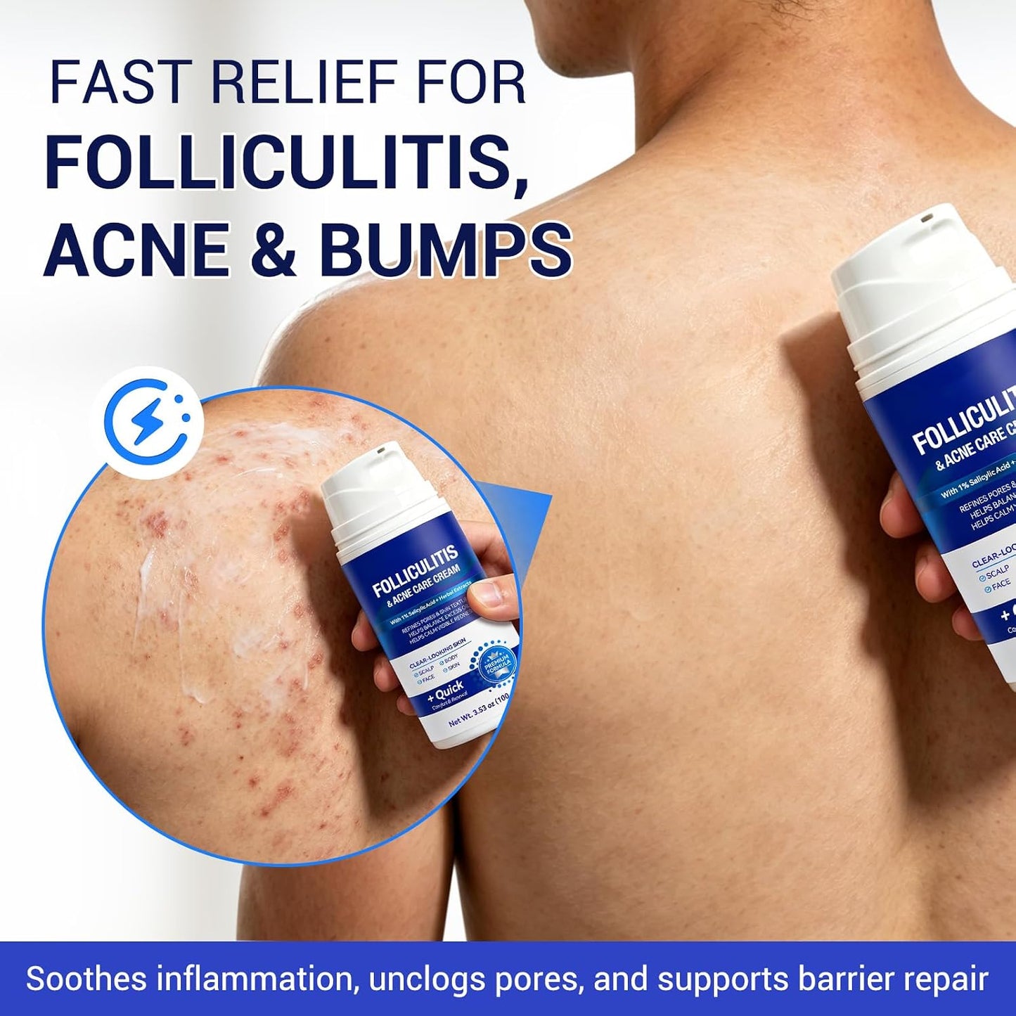 Folliculitis & Acne Cream - Salicylic Acid & Herbal Extracts for Scalp, Face, Body | Soothes Irritated Skin, 100g