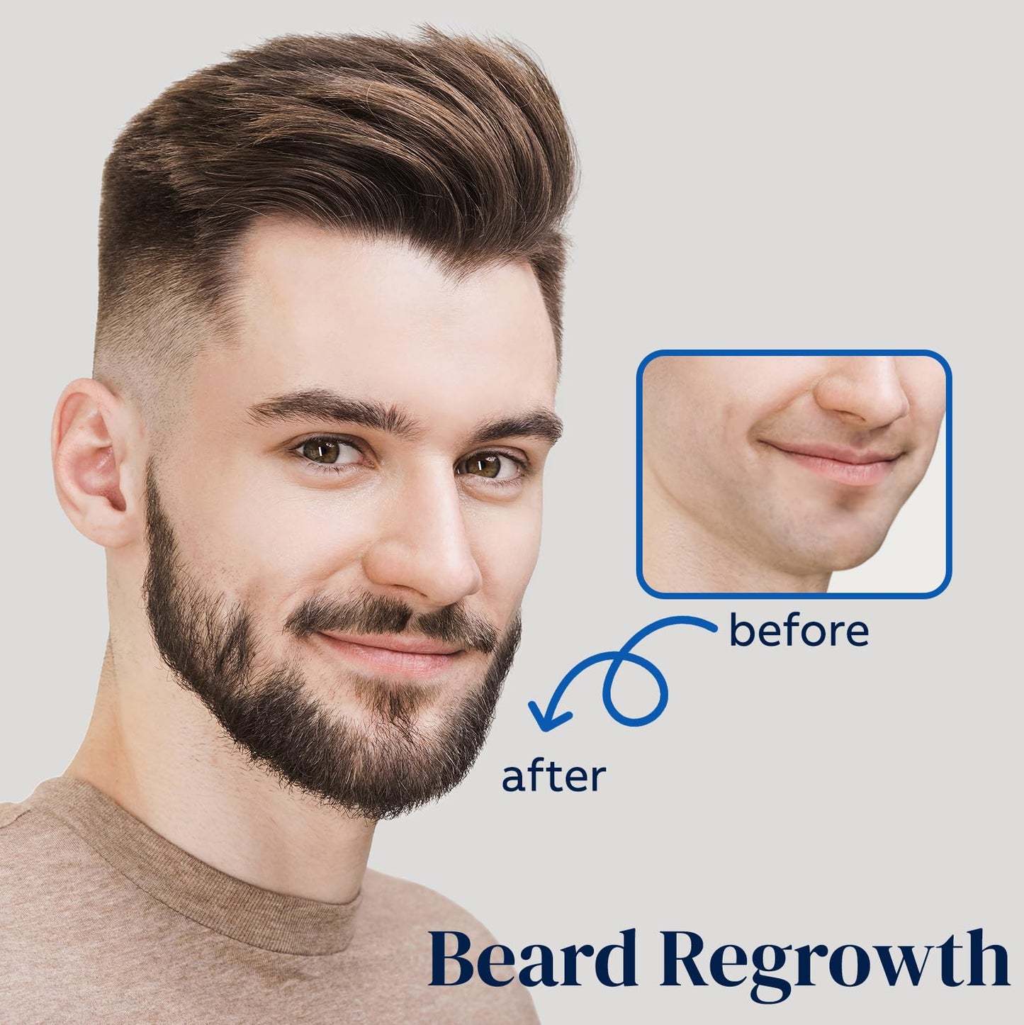 5% Minoxidil for Men Beard and Hair, Minoxidil for Women Hair Growth Spray with Biotin & Castor Oil, Strengthens Weak Roots, Repairs Thinning Hair Spray (180ml, 6PCS-Spray)