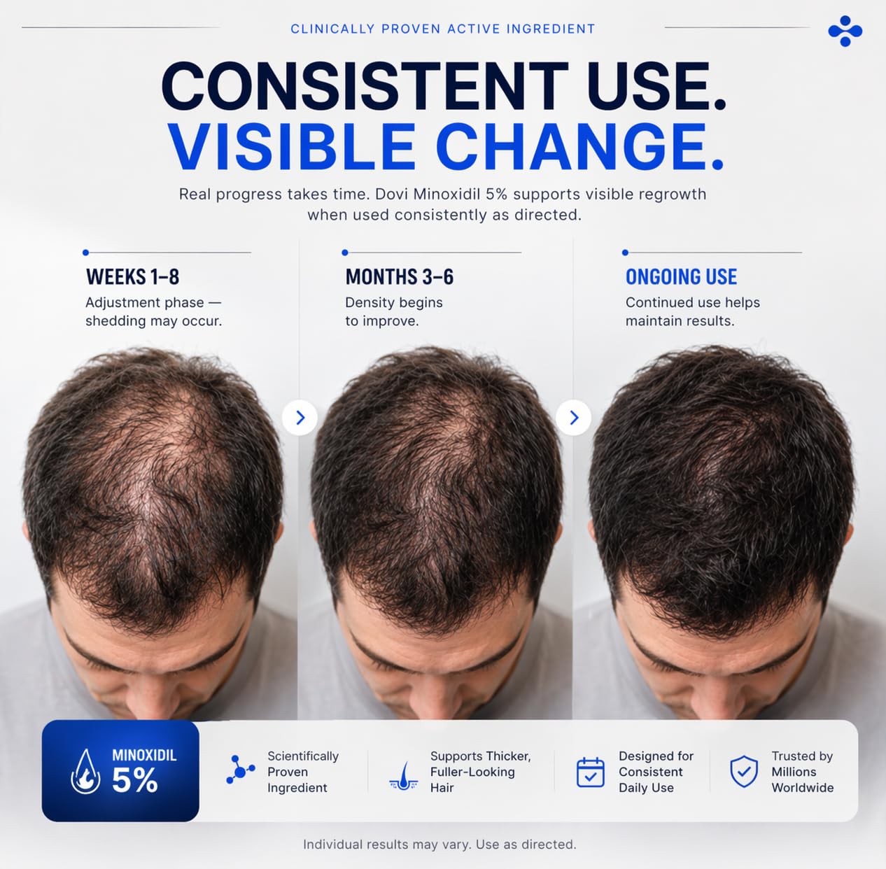 Dovi Minoxidil 5% Hair Regrowth Treatment for Men – Extra Strength Advanced Topical Solution, 6 Month Supply, Helps Regrow Hair and Prevent Hair Loss