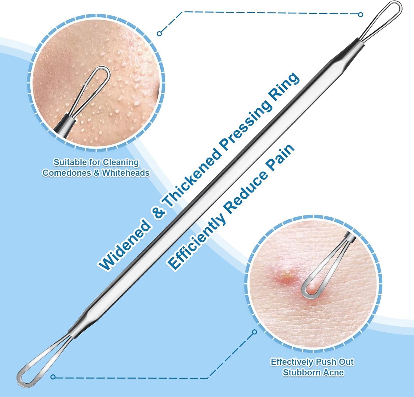 Stainless Steel Blackhead Remover Kit - Surgical Grade Pimple Extractor Tool | 2-Piece Set for Face & T-Zone