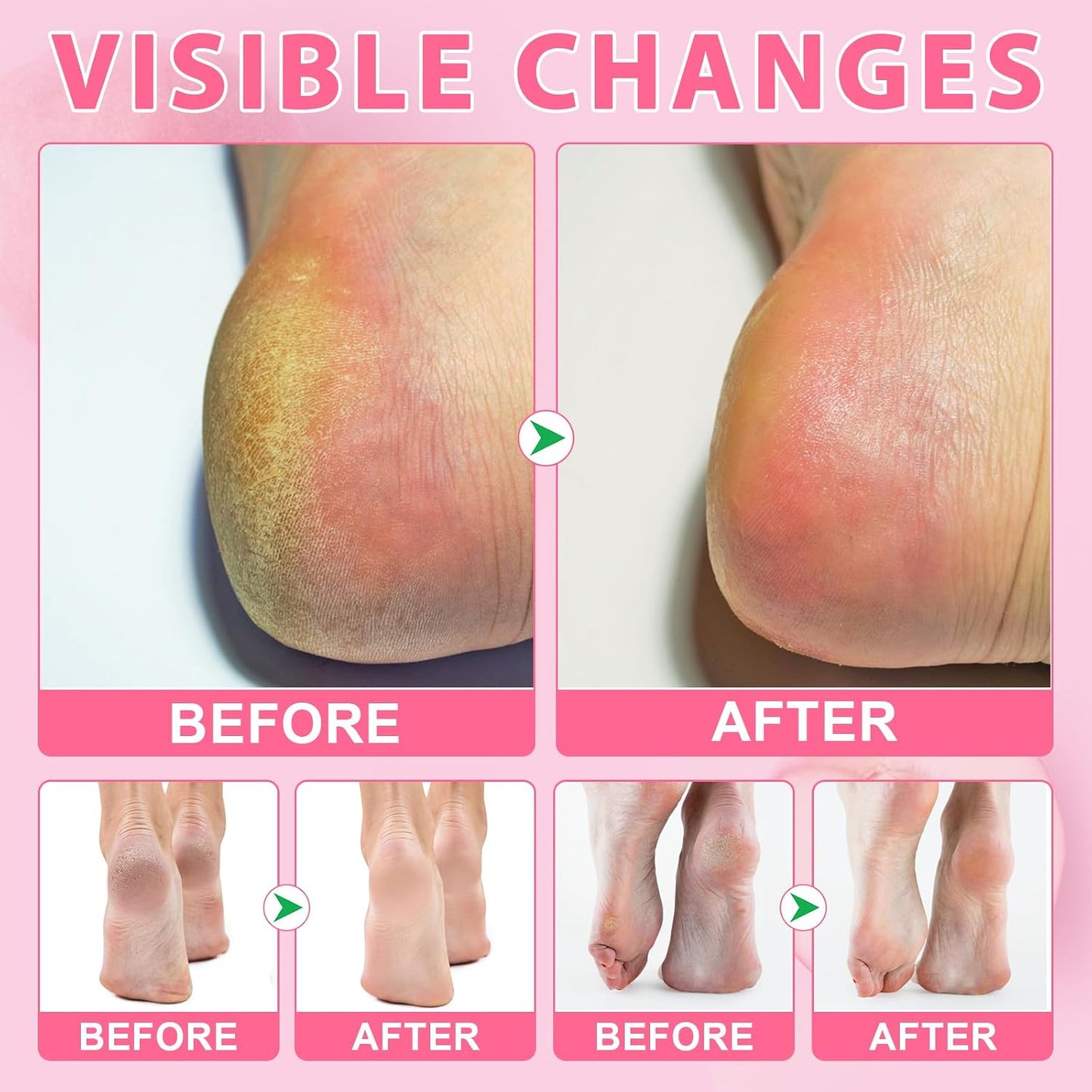 Urea Cream 60% & Salicylic Acid 2% Foot Repair Balm Stick - Intensive Moisturization & Callus Removal | Peach Scent | 1.41 Oz