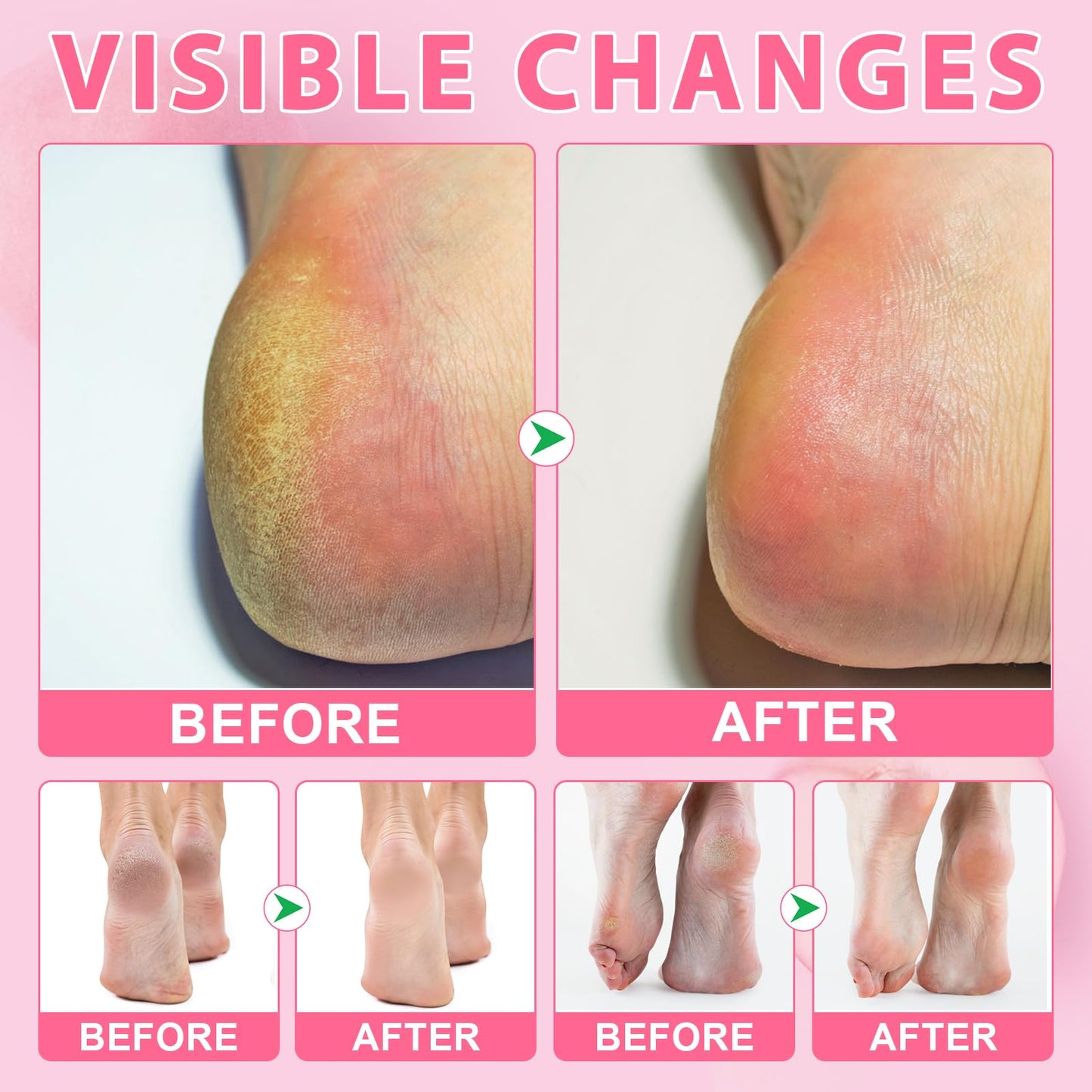 2 Pack Urea Cream 60% Plus Salicylic Acid 2% Foot Balm Stick for Dry Cracked/Chapped Heel, Skinned knees, Hand Intensively Hydration/Moisturization, Callus Removal/Softening/Soothing-Peach Scent|40g