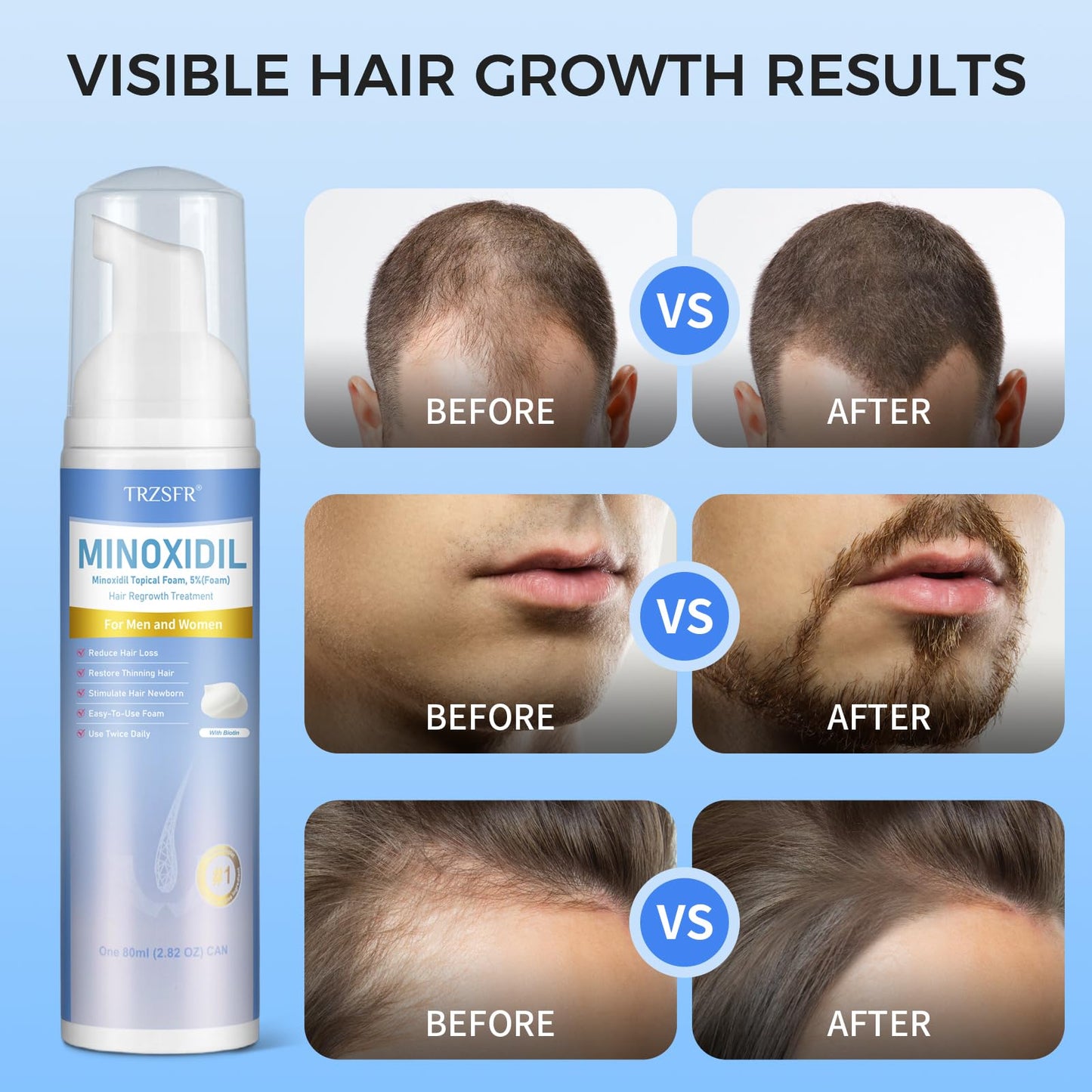 Trzsfr 5% Minoxidil Foam for Men & Women