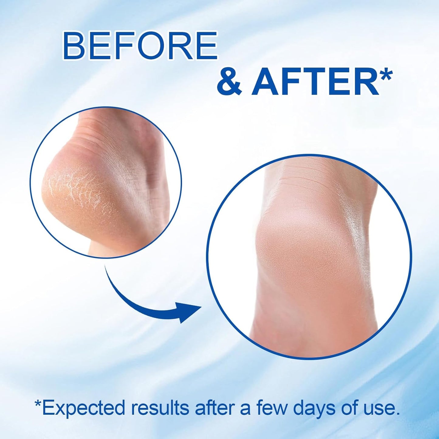 Urea Cream Stick with Salicylic Acid - Maximum Strength Foot Cream for Dry Cracked Heels | Non-Greasy, Fast Acting, 2 oz
