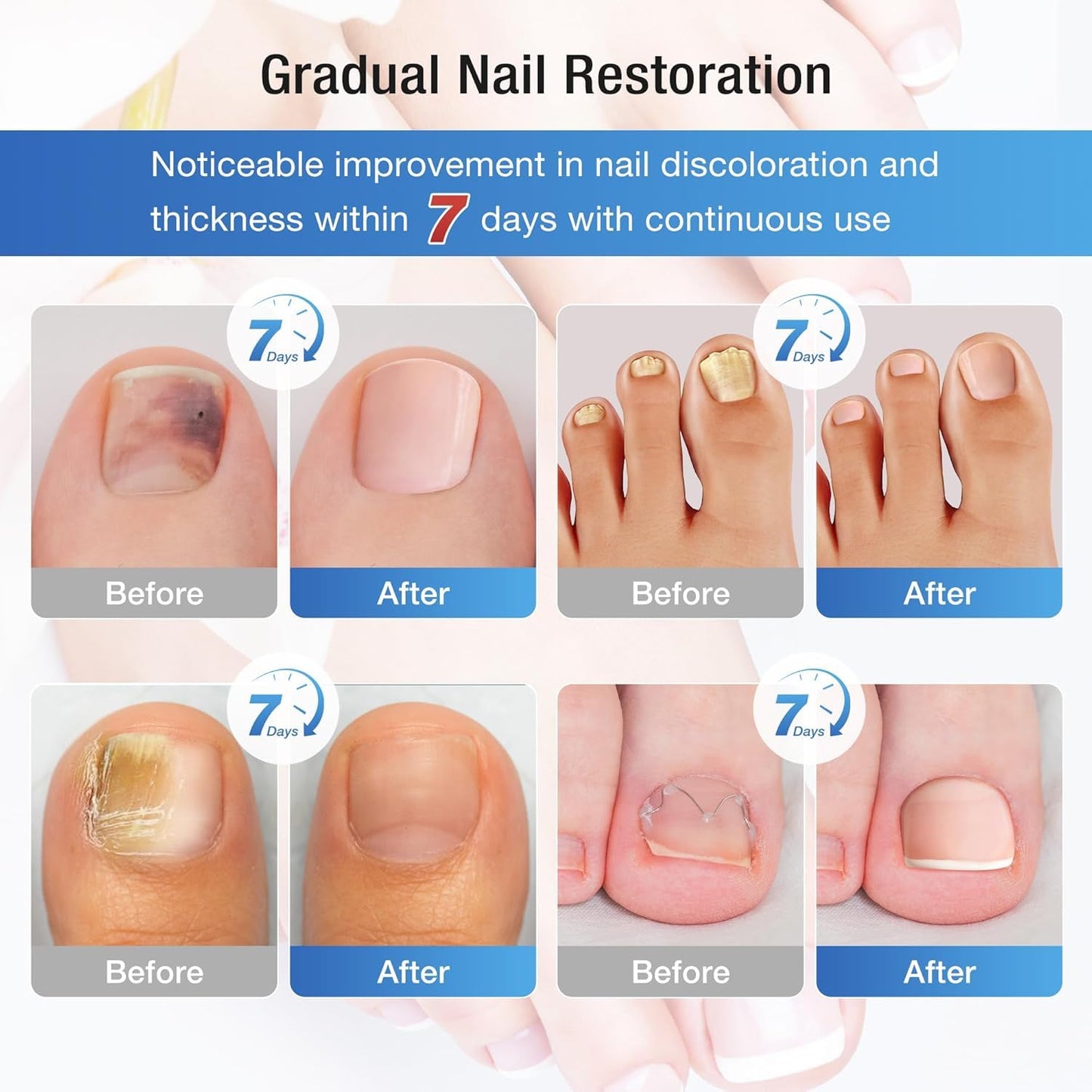 Fungal Nail Patches 60 Pcs,Upgraded Toe Nail Fungus Treatments,Nail Fungus Treatment Extra Strength,Toenail Fungus Treatment with Hydrogel for Overnight Repair Nail Fungus Patches