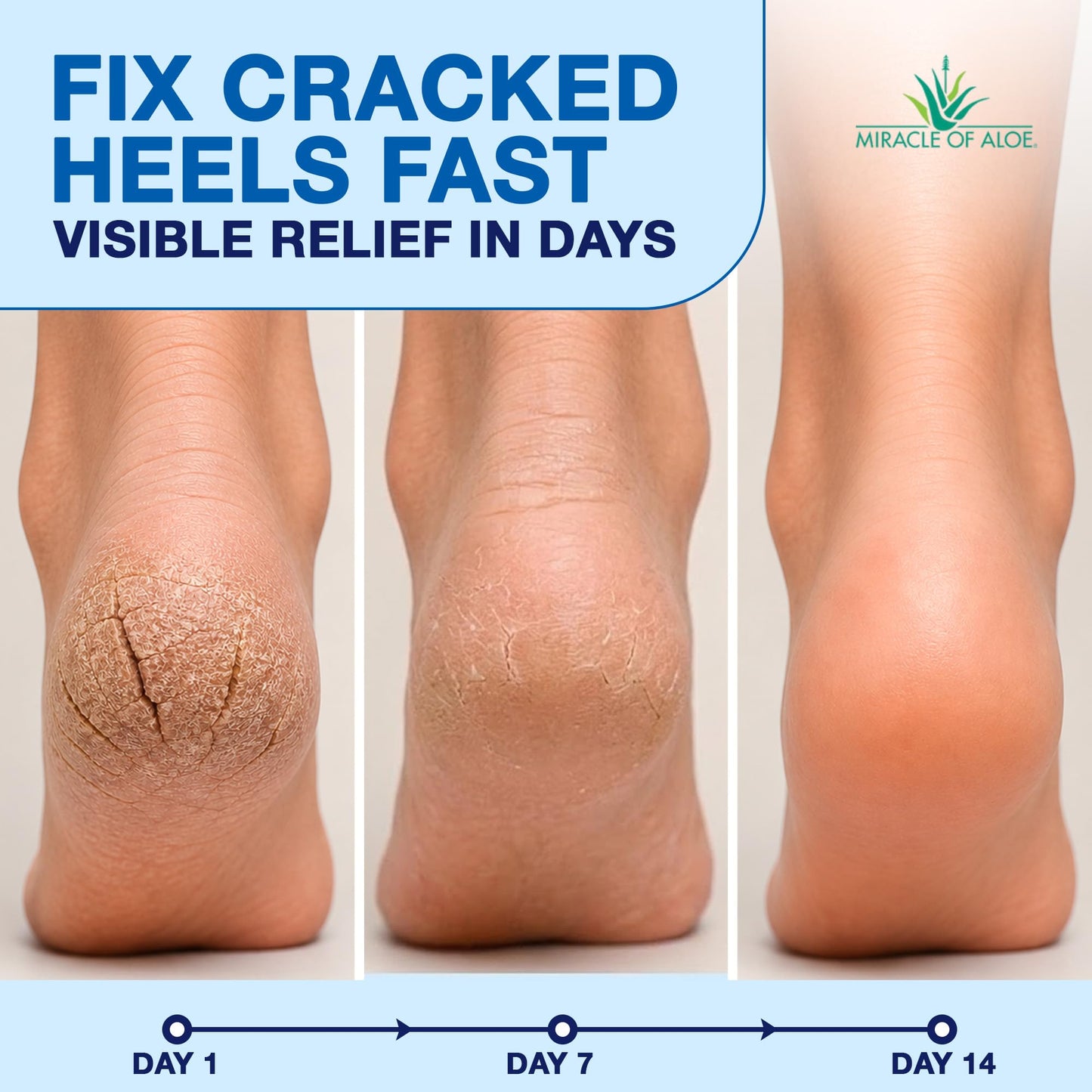 Heel Balm for Dry Cracked Feet - Miracle Heel Stick with Gel Socks - Moisturizes & Relieves Hard, Cracked Heels - Silicone Gel Infused Socks, Breathable & Washable - One Size Fits All