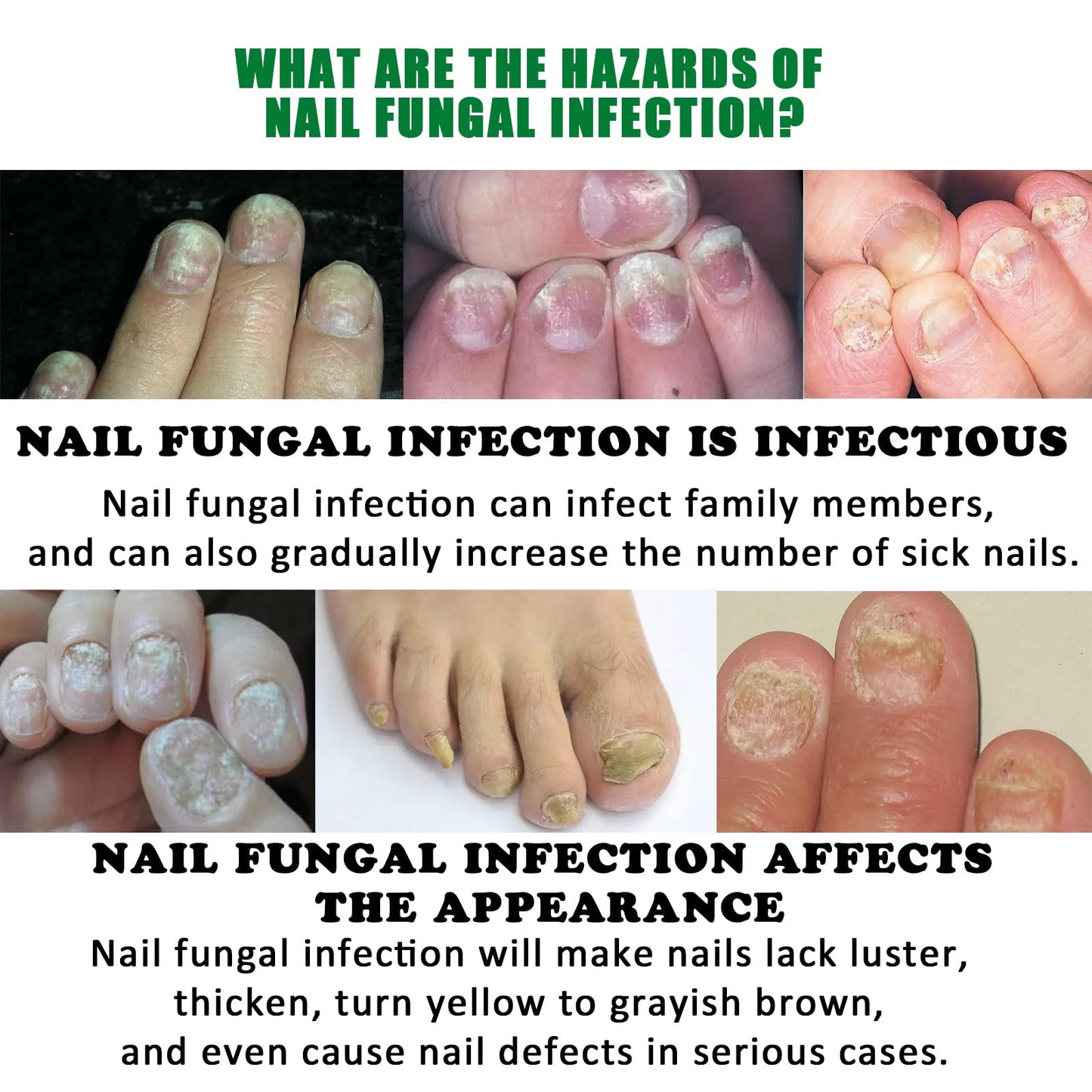 Ginger Nail Growth Serum, Nail Serum 7 Days Intense Repair for Nails Edges, 30ml