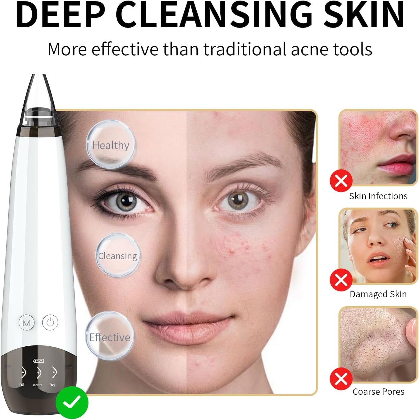 Blackhead Remover Pore Vacuum Cleaner - USB Rechargeable with 3 Suction Levels & 6 Probes | Acne Extractor Tool for Women
