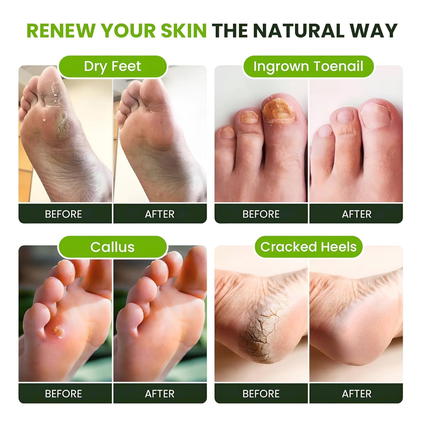 Tea Tree Oil Foot Soak - Epsom Salt for Toenail Repair & Athlete's Foot | 16 oz Spa Treatment