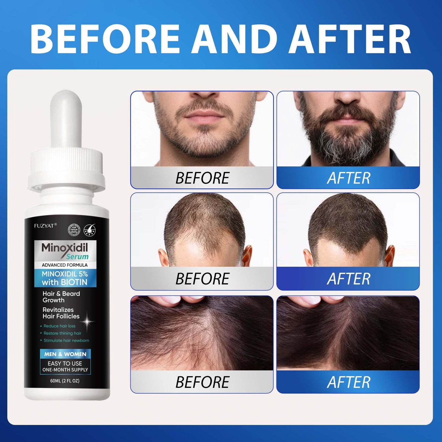 5% Minoxidil for Men, Minoxidil for Women Hair Growth Treatment, Beard Growth Serum, Biotin & Castor Oil Enriched,Strengthens Weak Roots, Repairs Thinning Hair (240ml)