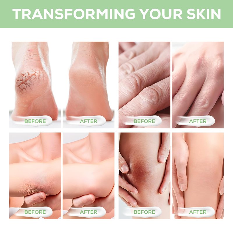 Mariayu Urea Cream 40%, with 2% Salicylic Acid 4.23 oz, Powerful Softening of Cracked Heels, Quick Absorption, Urea Foot Cream for Dry Heels, Hands, Feet, Knees & Elbows