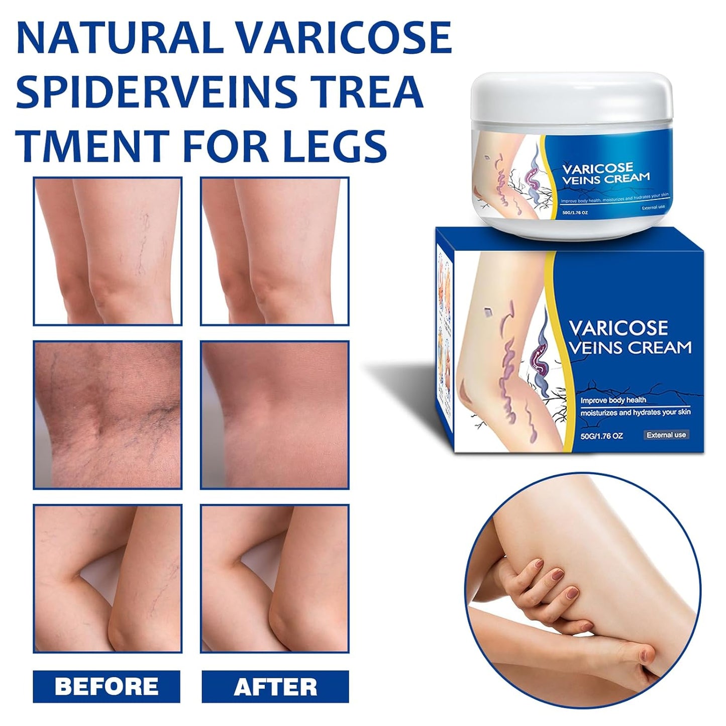 Varicose Veins Cream - Natural Treatment for Spider Veins & Heavy Legs | Refreshing Non-Sticky Formula, 1 Pack