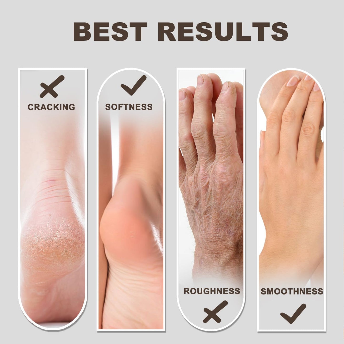 60% Urea Foot & Hand Cream, Feet Moisturizer for Dry Cracked Heels, 7 oz