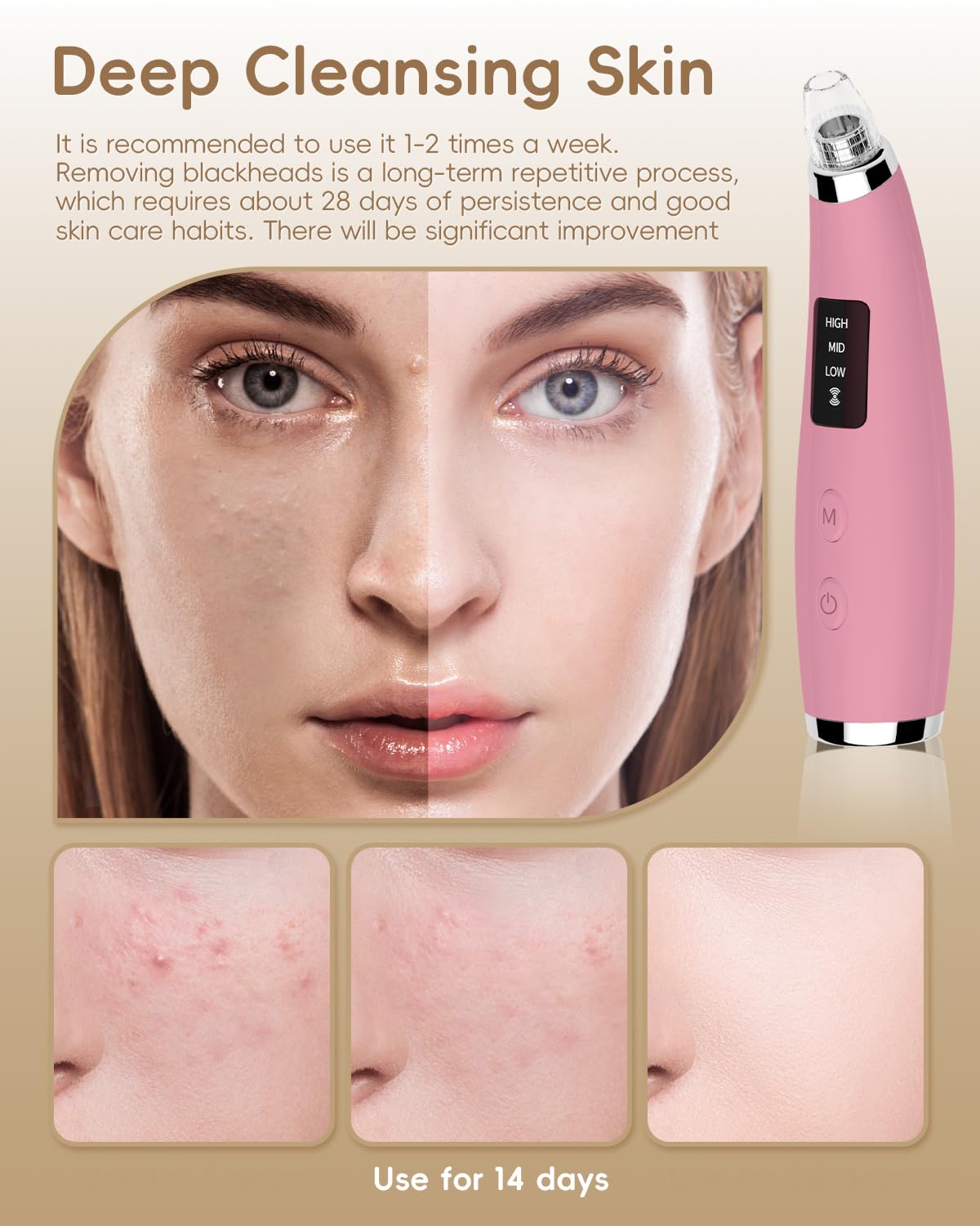 Pore Vacuum Blackhead Remover - Pore Extractor with 5 Attachments & 3 Suction Levels - Blackhead Remover Tools for Women and Men (Pink)