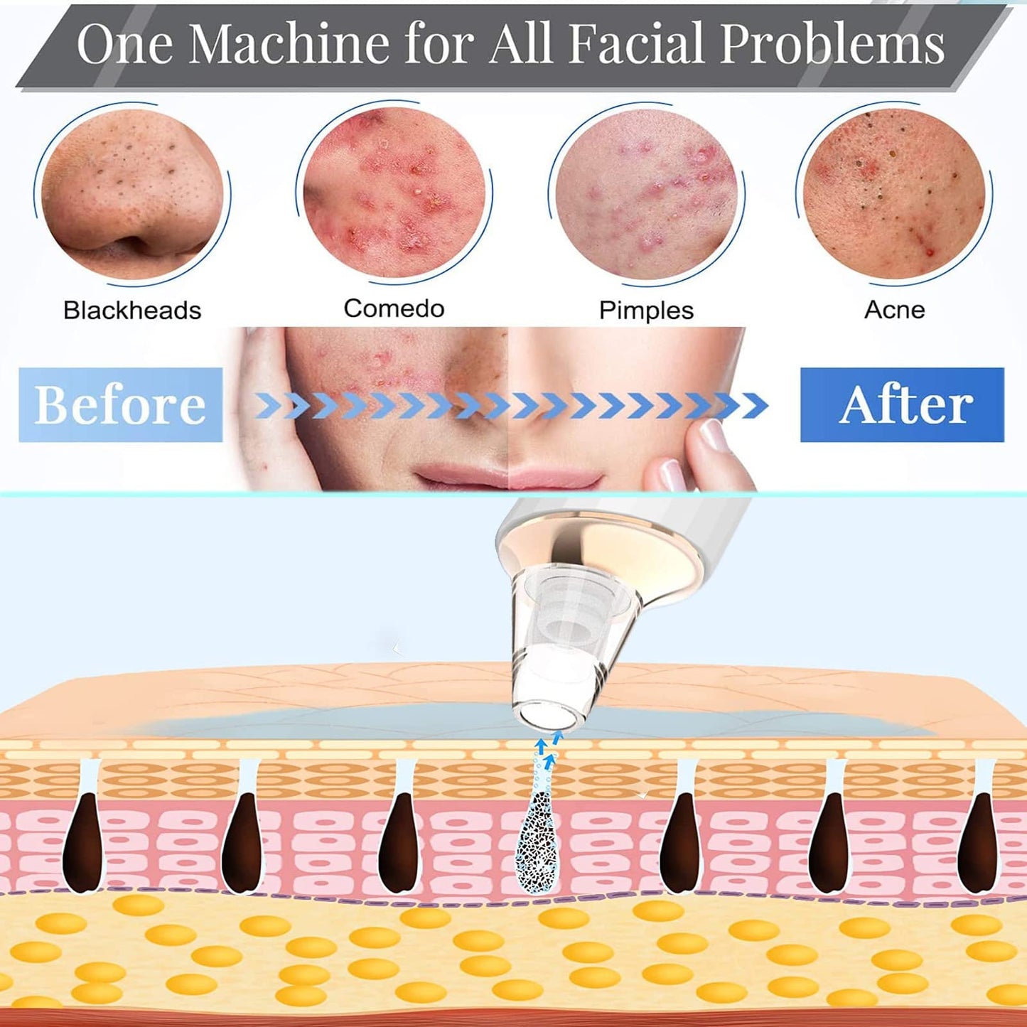 Blackhead Remover Pore Vacuum,Newest Upgraded USB Rechargeable Facial Pore Cleaner Blackhead Removal Kit with 3 Suction Power,5 Probes Black Head Extractions Tool for Women & Men