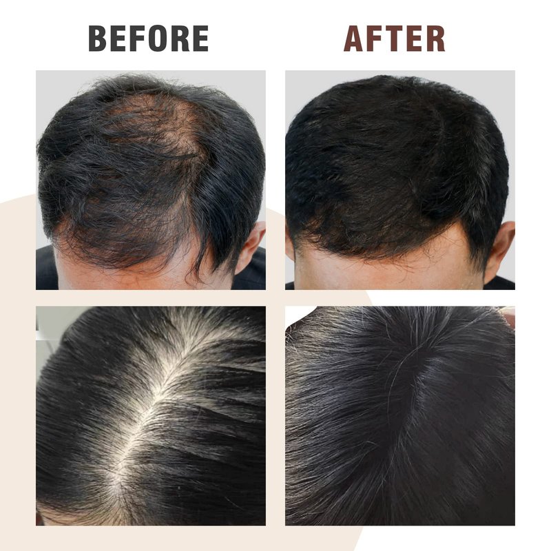 Anti Hair Loss Hair Serum, Repairing Hair Scalp with Herbal Extracts,Scalp Massage Serum Water Base with Ginseng,Ginger,Polygonum Multiflorum for Men and Women,Daily Use
