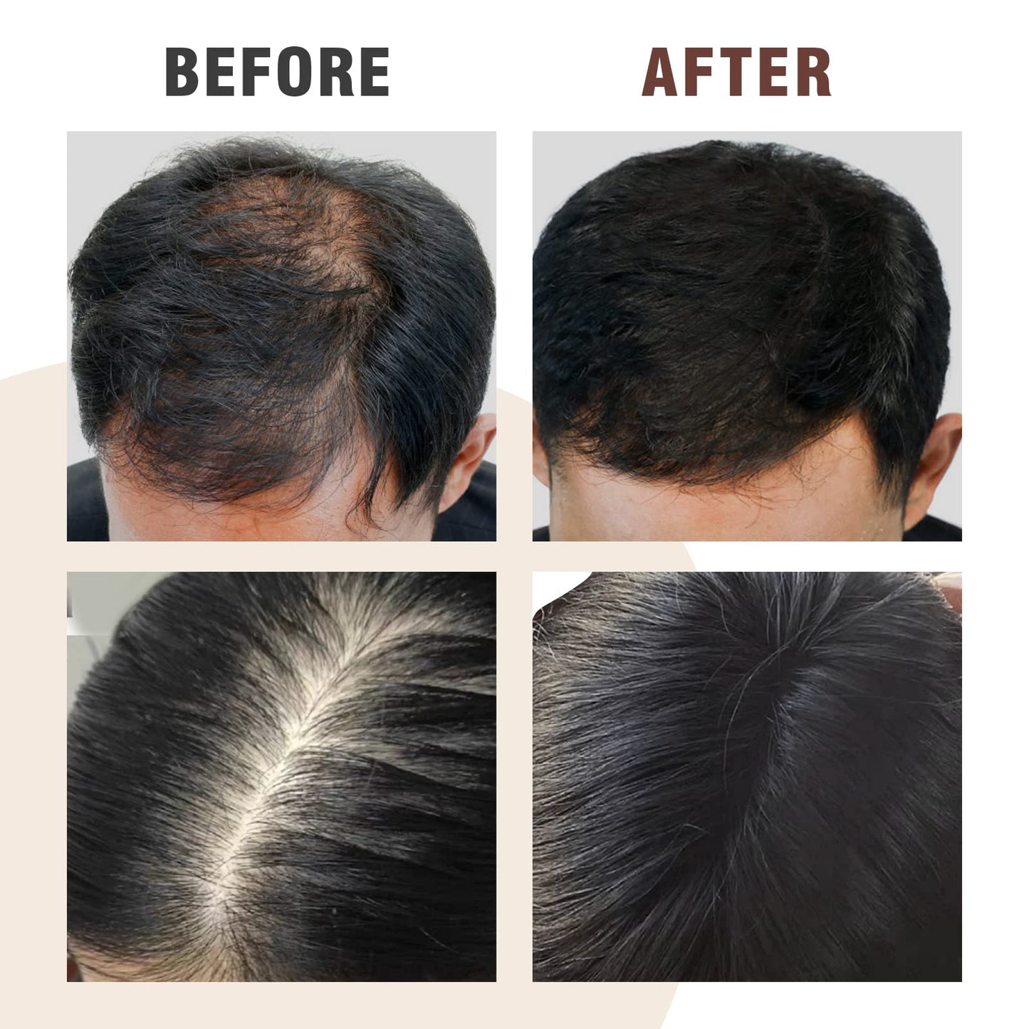 5 in 1 Herbal Anti Hair Thinning Shampoo, 100% Natural Organic Hair Wash Anti Hair Loss Shampoo Infused with Ginger,Ginseng, Polygonum Multiflorum,Regrowth HairCare Treatment For Women Men,Daily Use