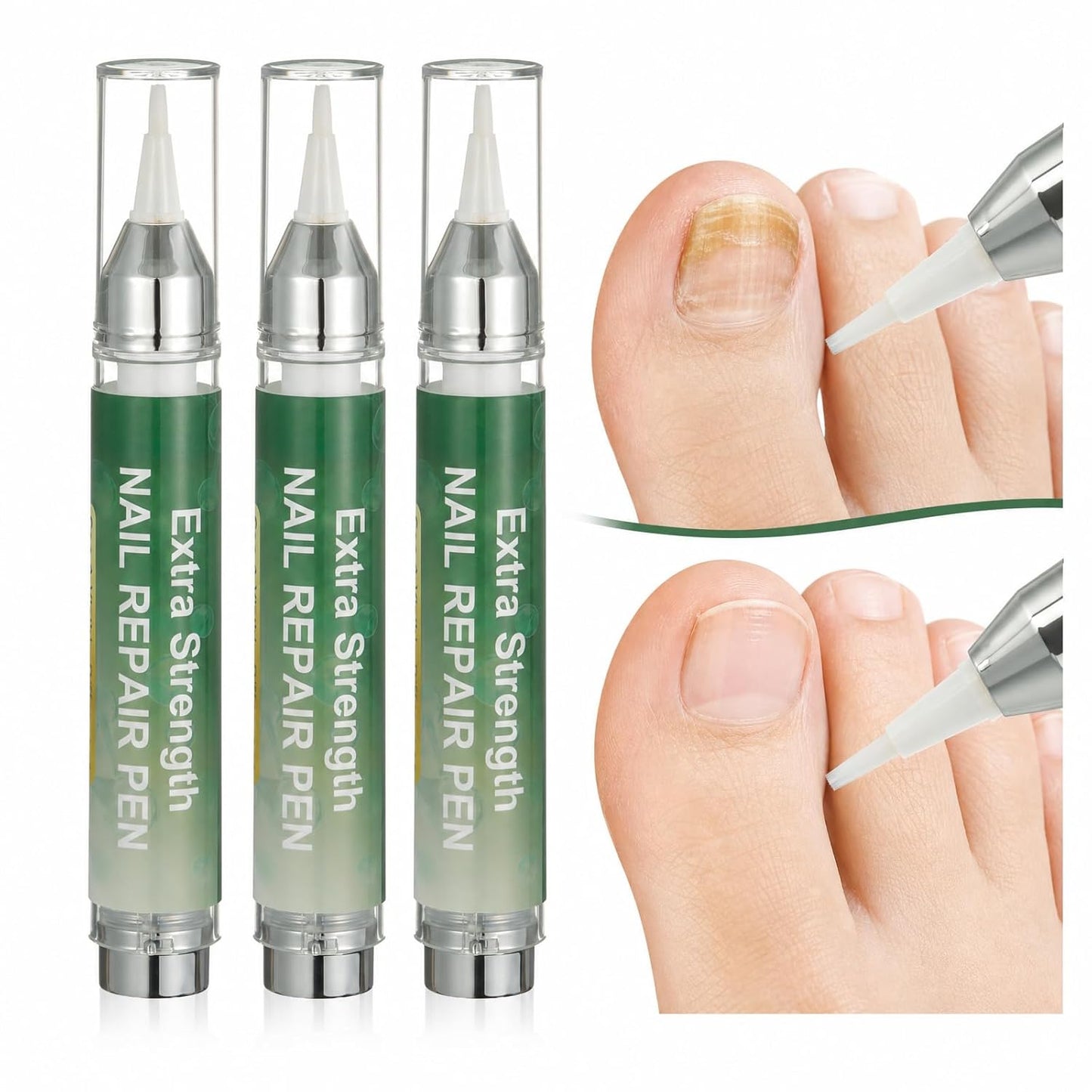 Nail Fungus Treatment Pen - 25% Undecylenic Acid Formula for Toenails & Fingernails | 16ml (3-Pack)