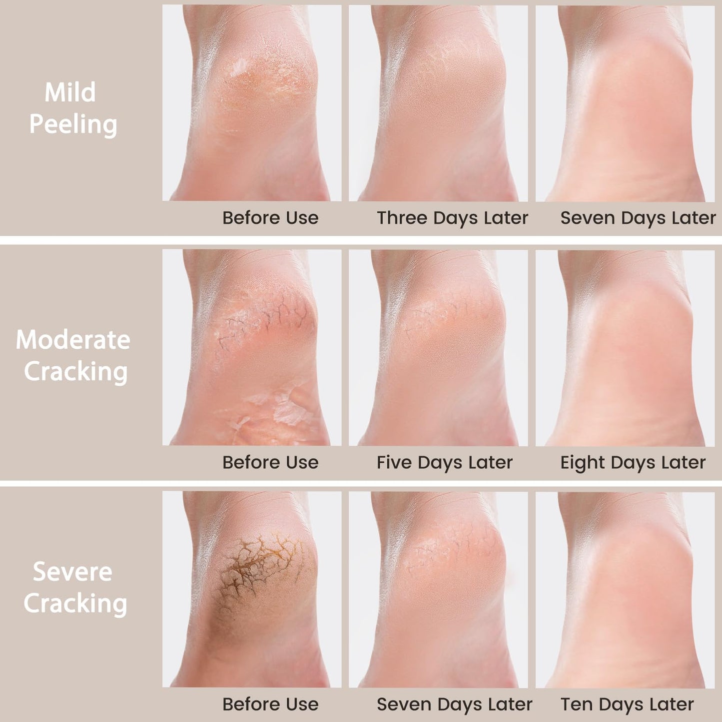 Mouriven Urea Cream 40 Percent - Foot & Hand Cream for Dry, Cracked Heels, Feet, Knees, Elbows, and Hands - Maximum Strength Urea Lotion for Softening and Moisturizing
