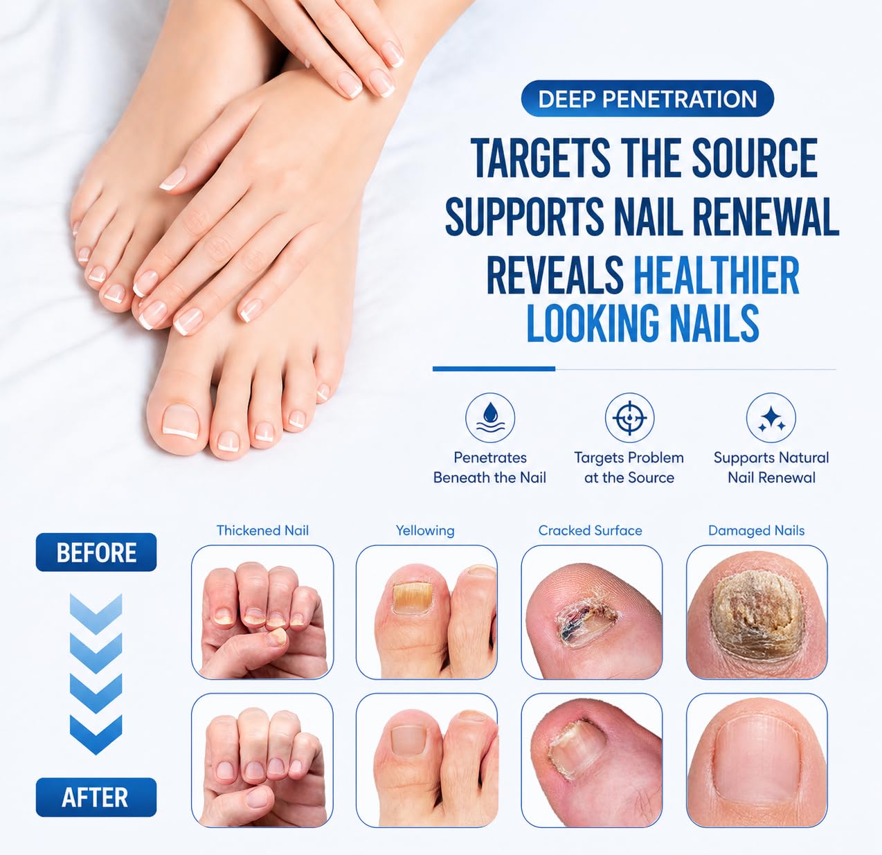 Nail Fungus Treatment - 25% Undecylenic Acid Liquid for Toenails & Fingernails | Extra Strength Nail Repair Solution, 2.02 Fl Oz