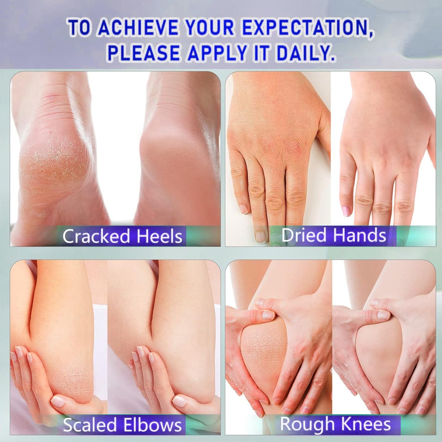 BERVEAL Urea Cream with 2% Salicylic Acid Foot Cream for Dry Cracked Heels, Heel Care Cream 5.29 Oz (Pack of 1)